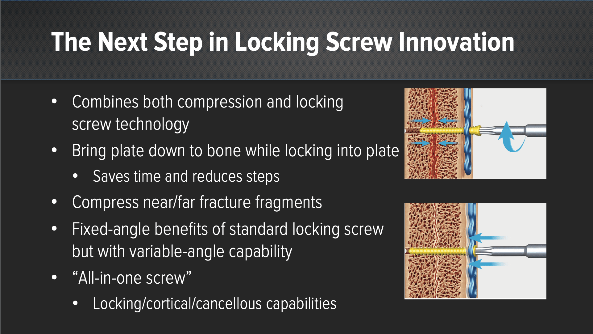 Calcaneus Fractures Using KreuLock™ Locking Compression Screws