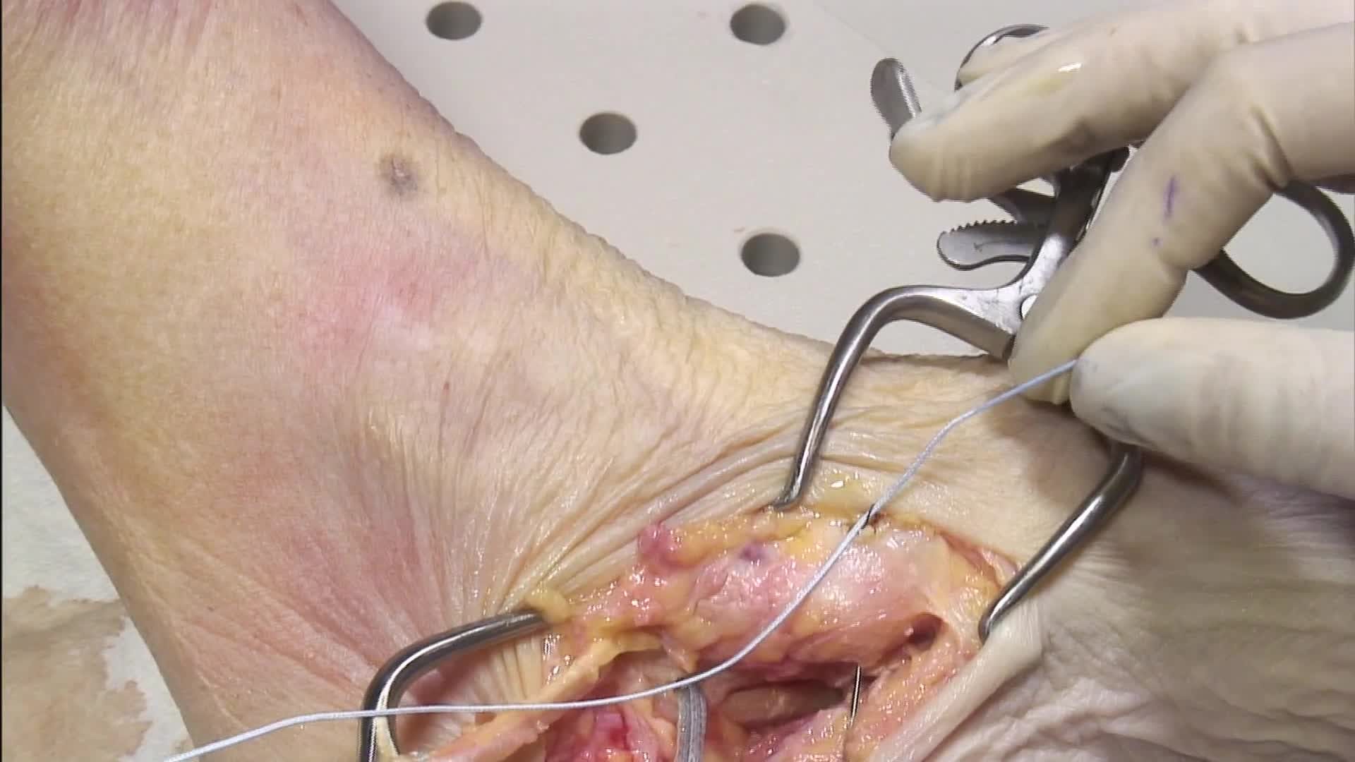 InternalBrace™ Ligament Augmentation Repair: Spring Ligament Surgical Technique