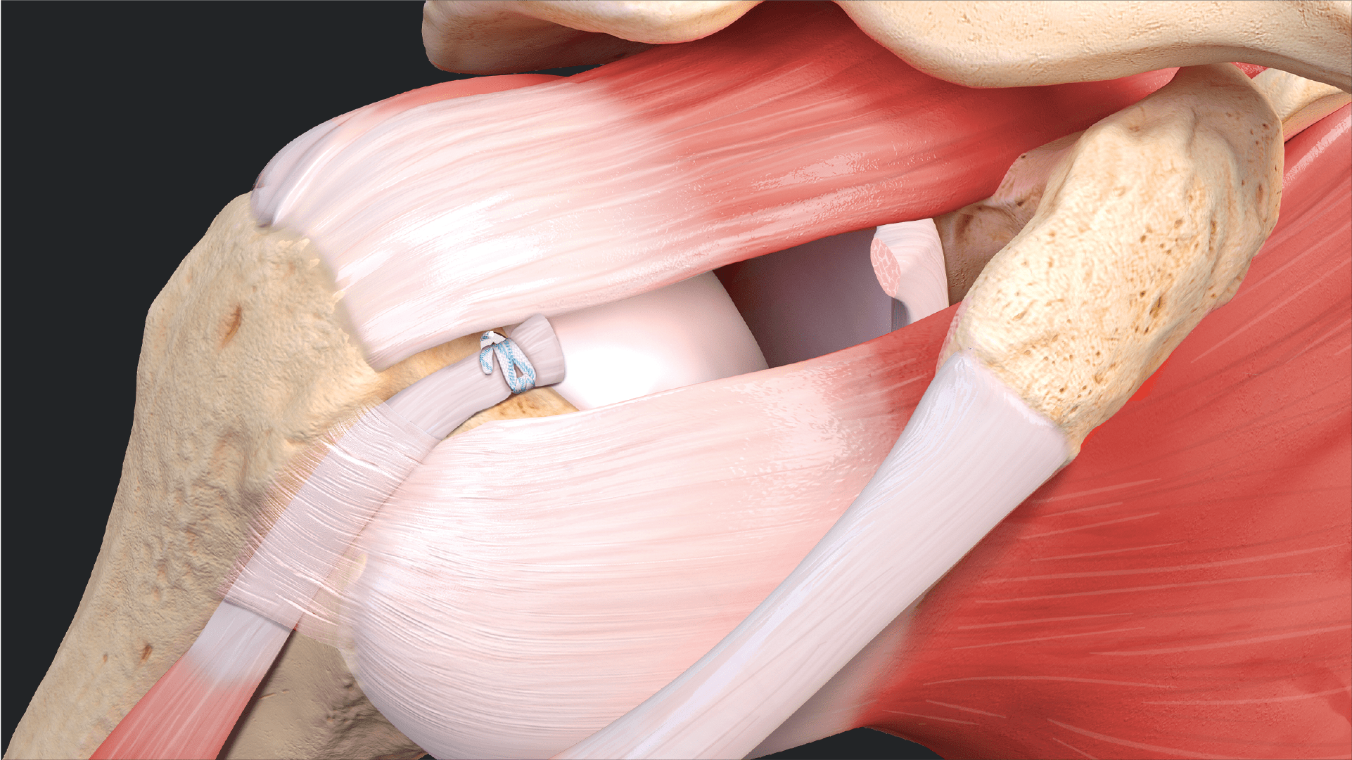 Proximal Biceps Tenodesis Using the Loop ‘N’ Tack™ Implant System