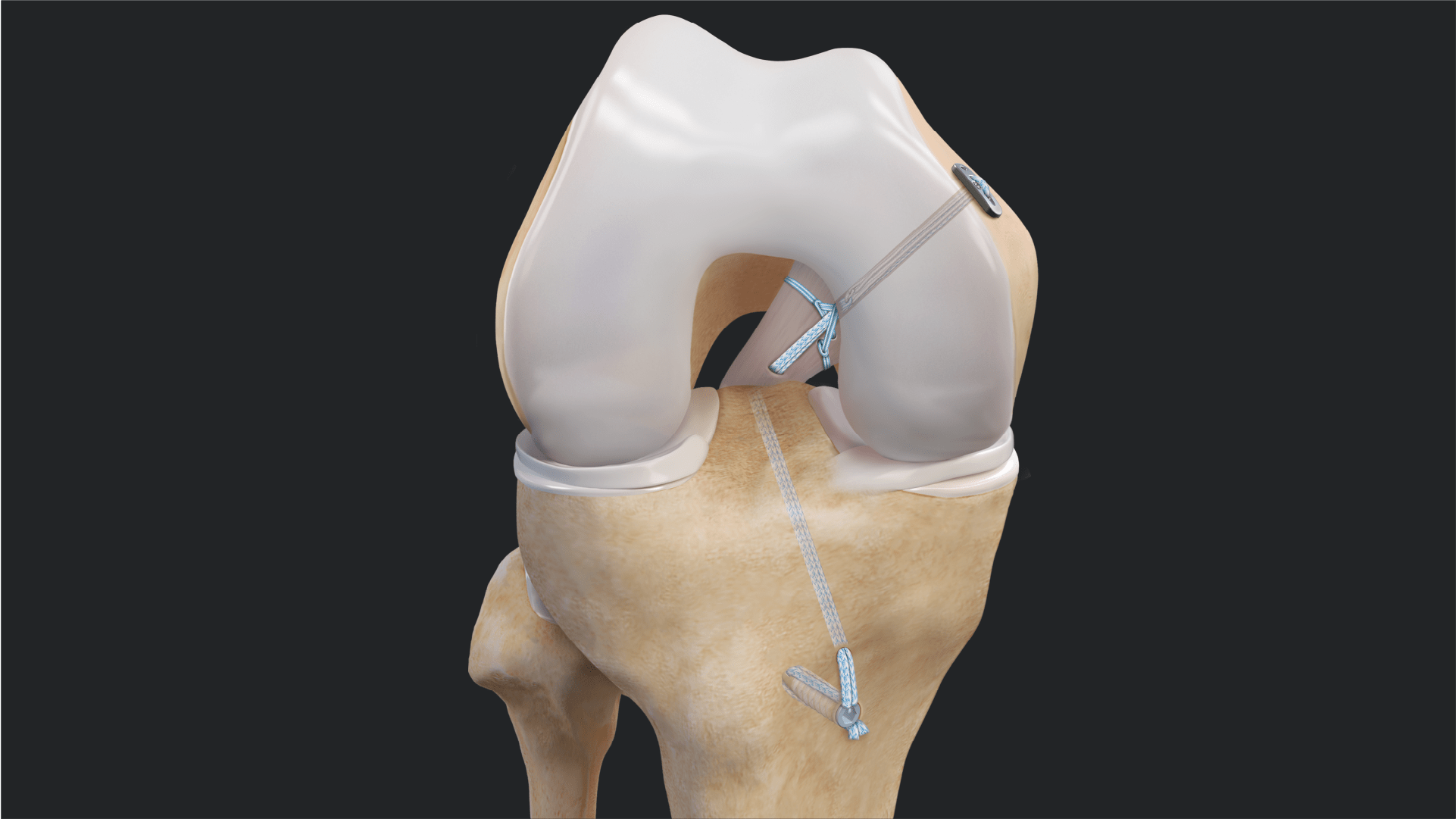 PCL Primary Repair Using the PCL Repair TightRope® Implant and FiberRing™ Sutures