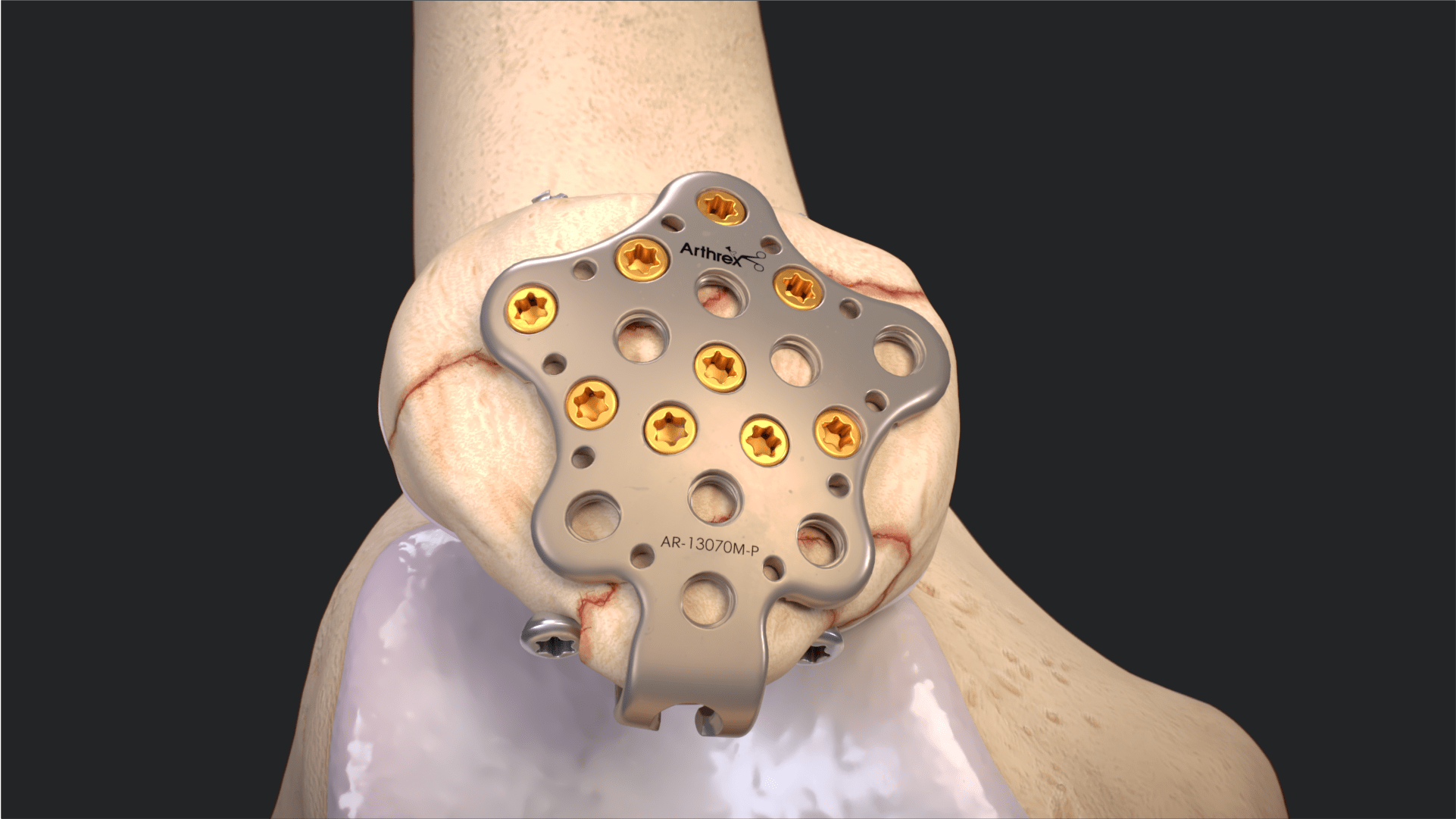 Patella SuturePlate™ II Plate for Pole Fractures