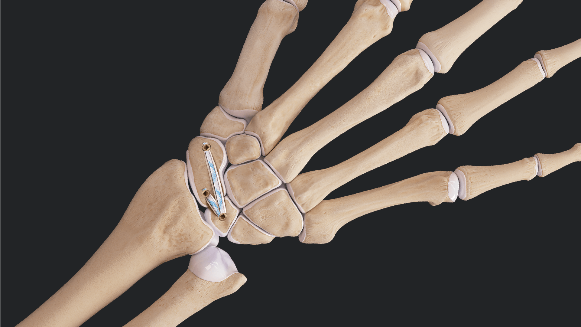 360° Scapholunate Reconstruction With the InternalBrace™ Ligament Augmentation Procedure