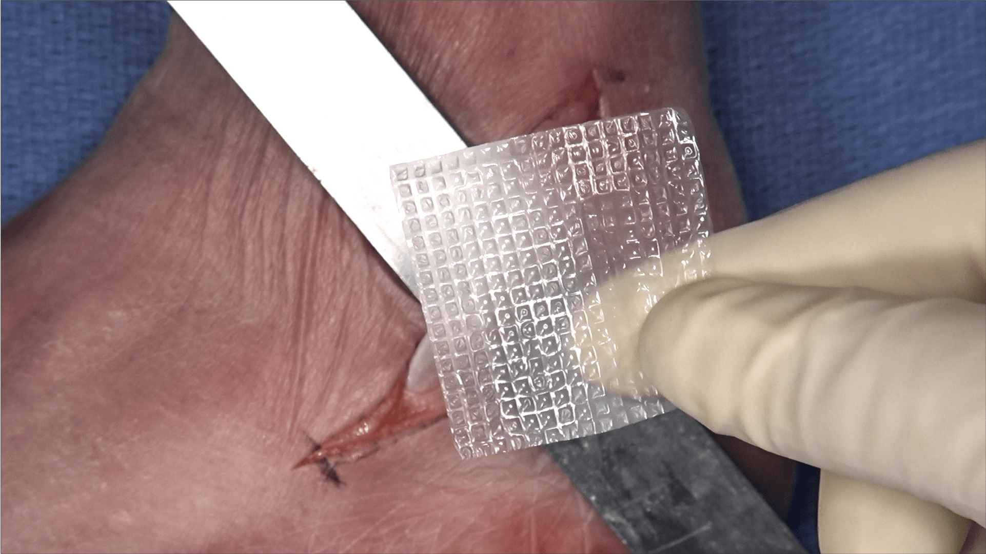 Peroneal Tendon Repair Using Biovance® Amniotic Membrane