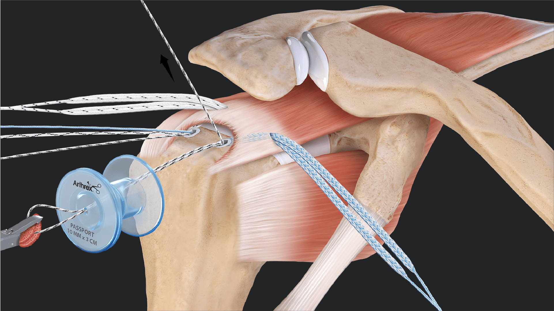 SpeedBridge™ Rotator Cuff Repair With AlloSync™ Demineralized Cancellous Sponge