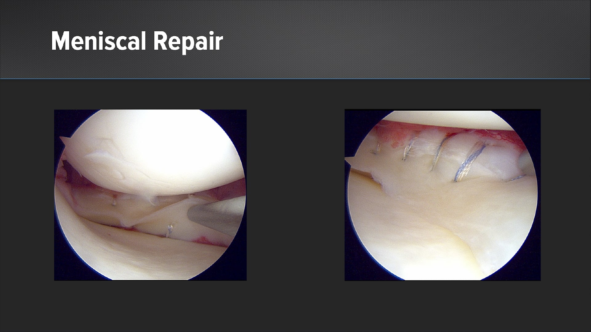 Segmental Meniscus Transplantation for Irreparable Meniscal Deficiencies