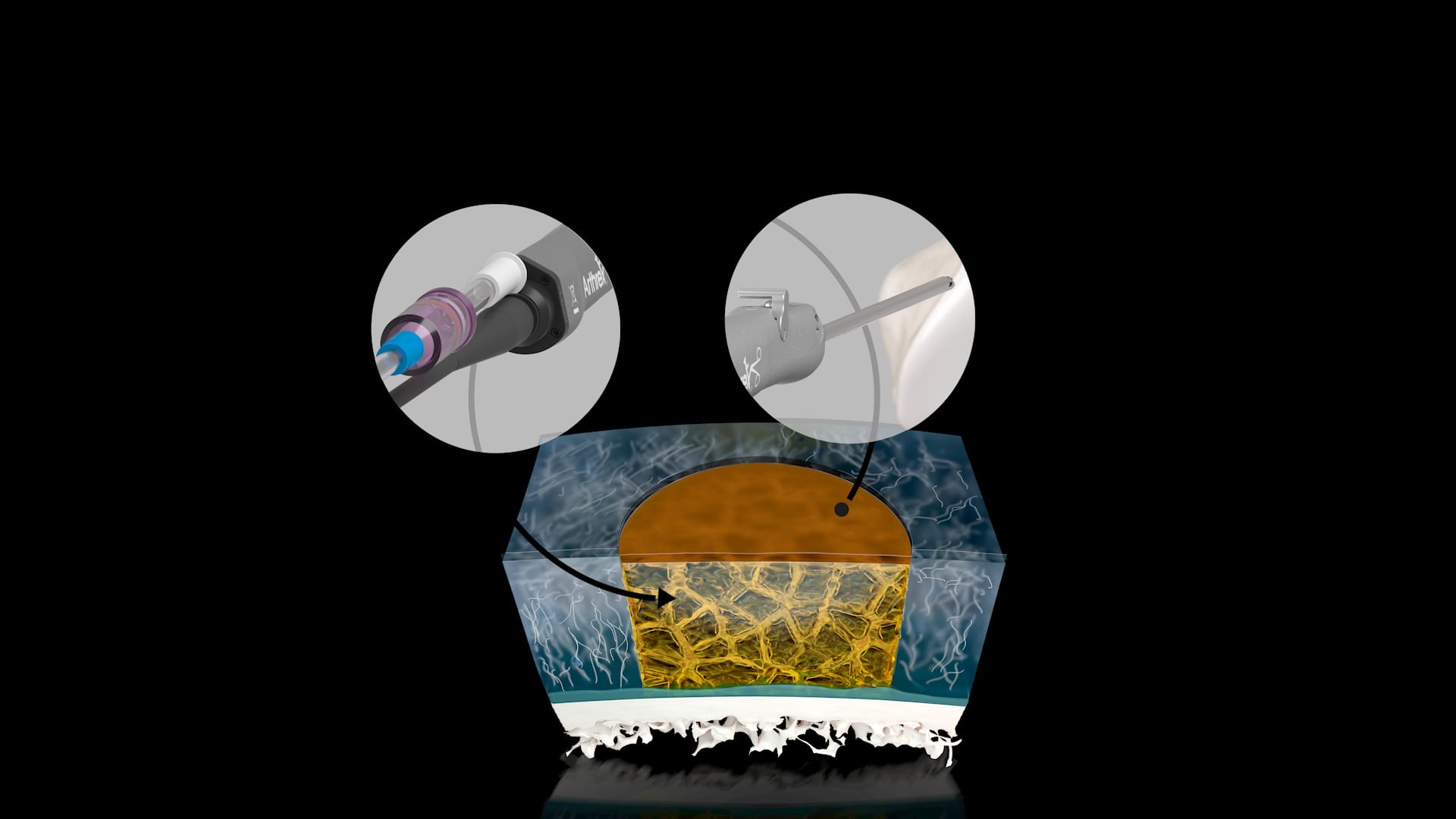 AutoCart™ Procedure for Symptomatic Cartilage Defects