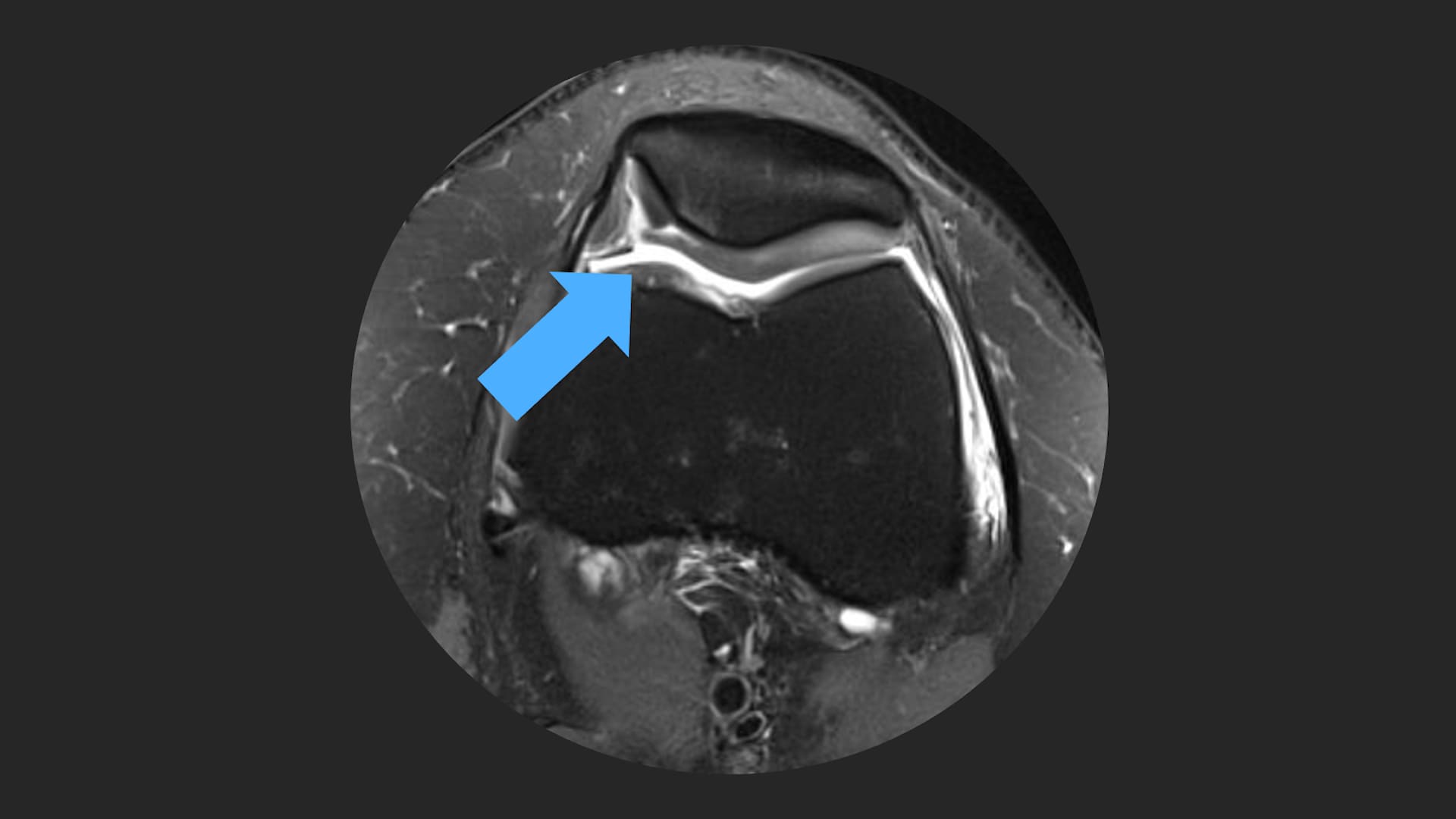 AutoCart™ Procedure: Case Presentation in a Young Athlete