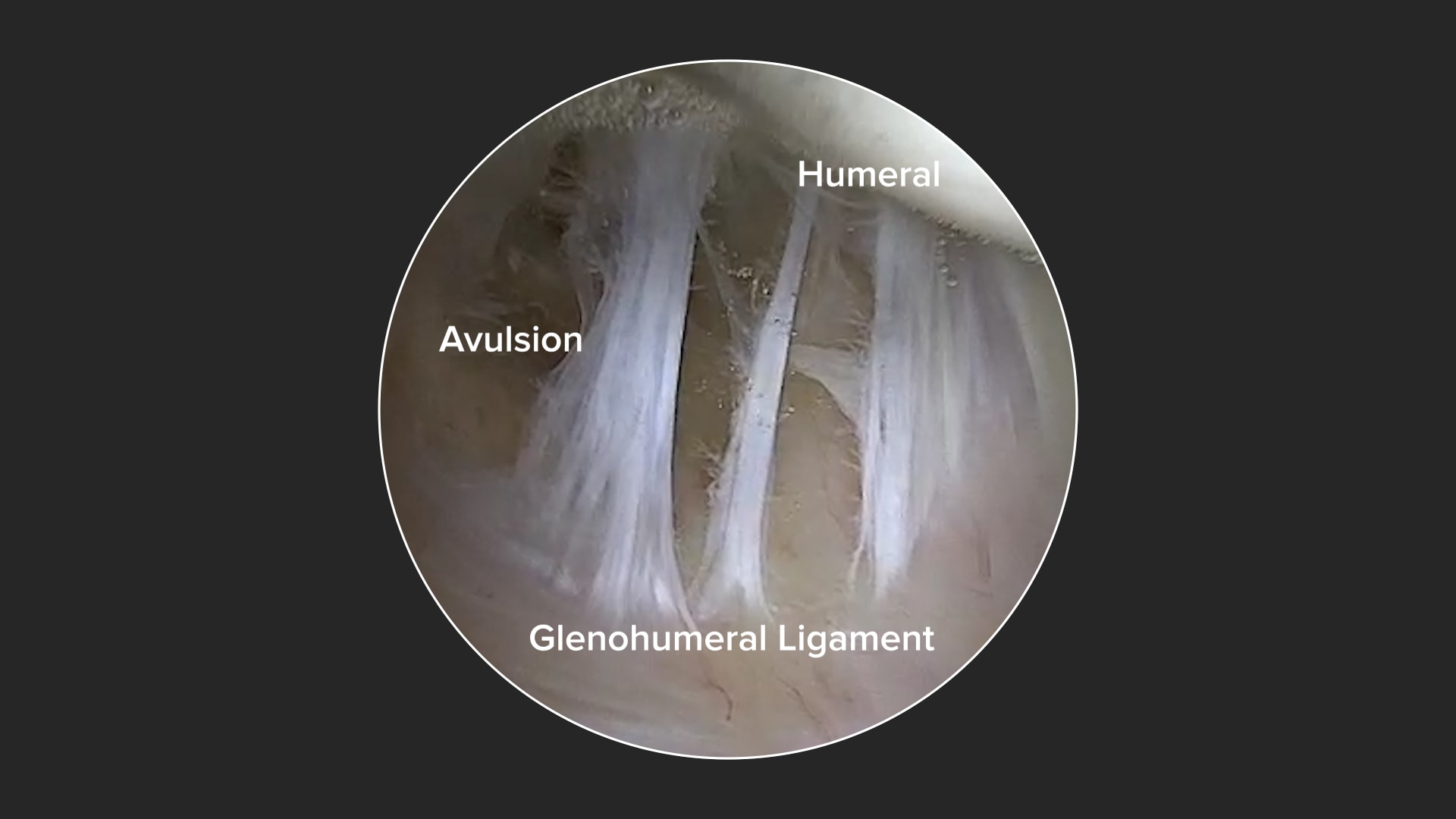 Inferior HAGL Repair Technique With Knotless 1.8 FiberTak® Soft Anchors