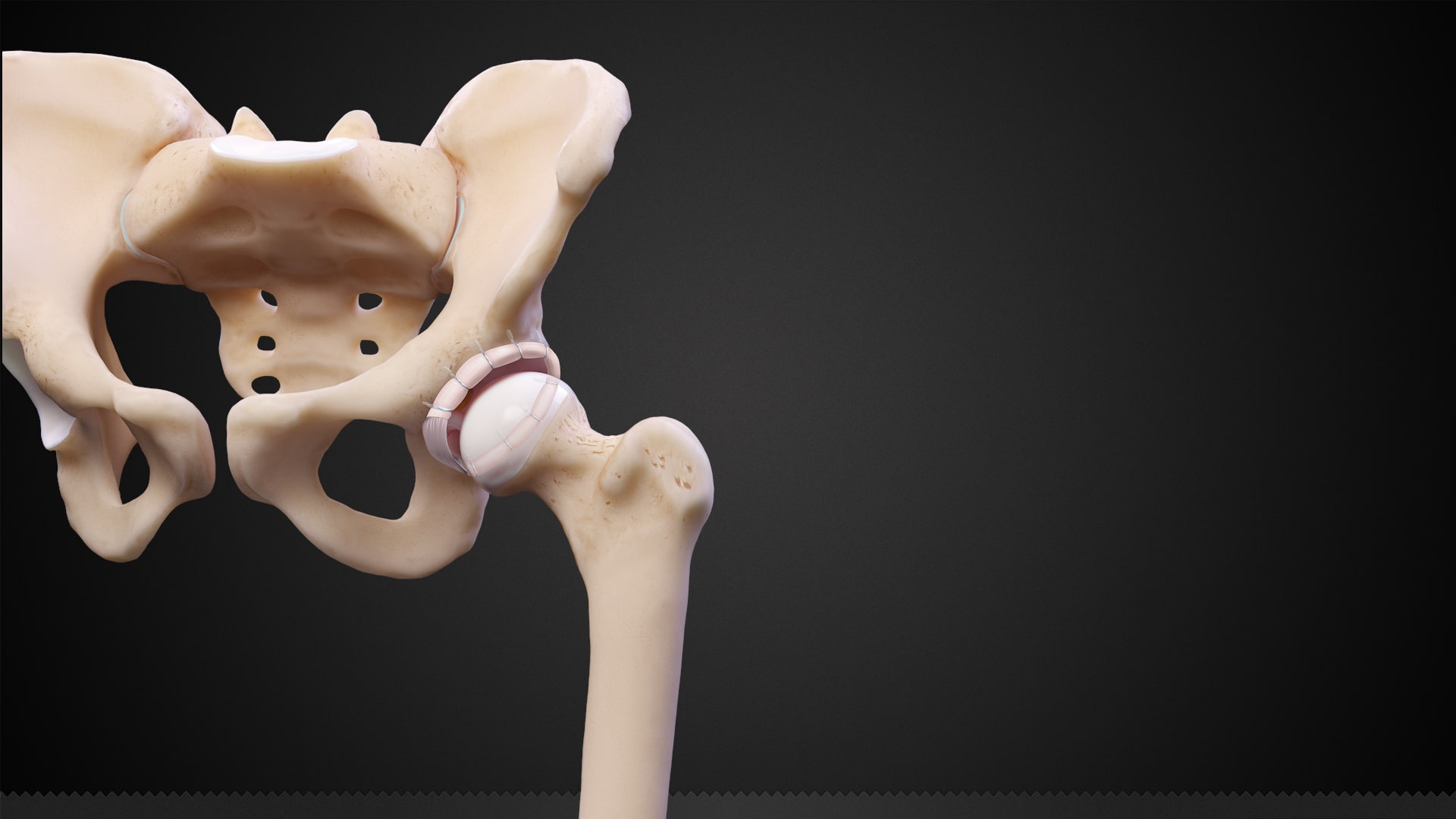 Acetabular Labral Reconstruction in Conjunction With a Periacetabular Osteotomy (PAO)