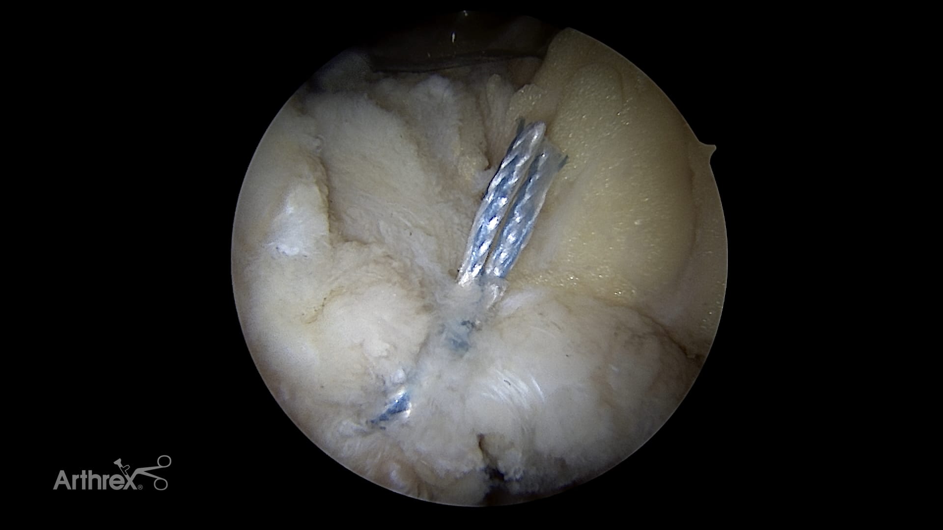 Hip Capsular Closure Using the LoopLoc™ Knotless Implant