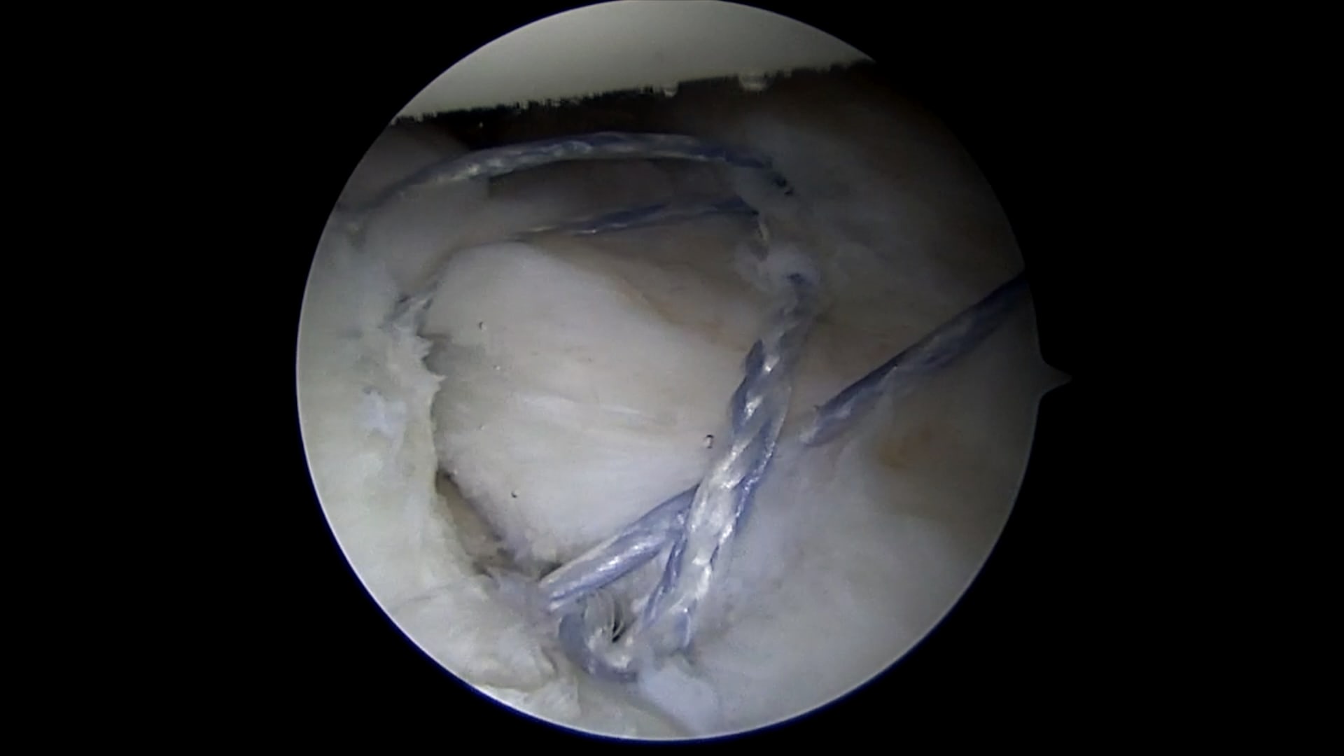 Arthroscopic Shoulder Stabilization Using Knotless FiberTak® Anchors