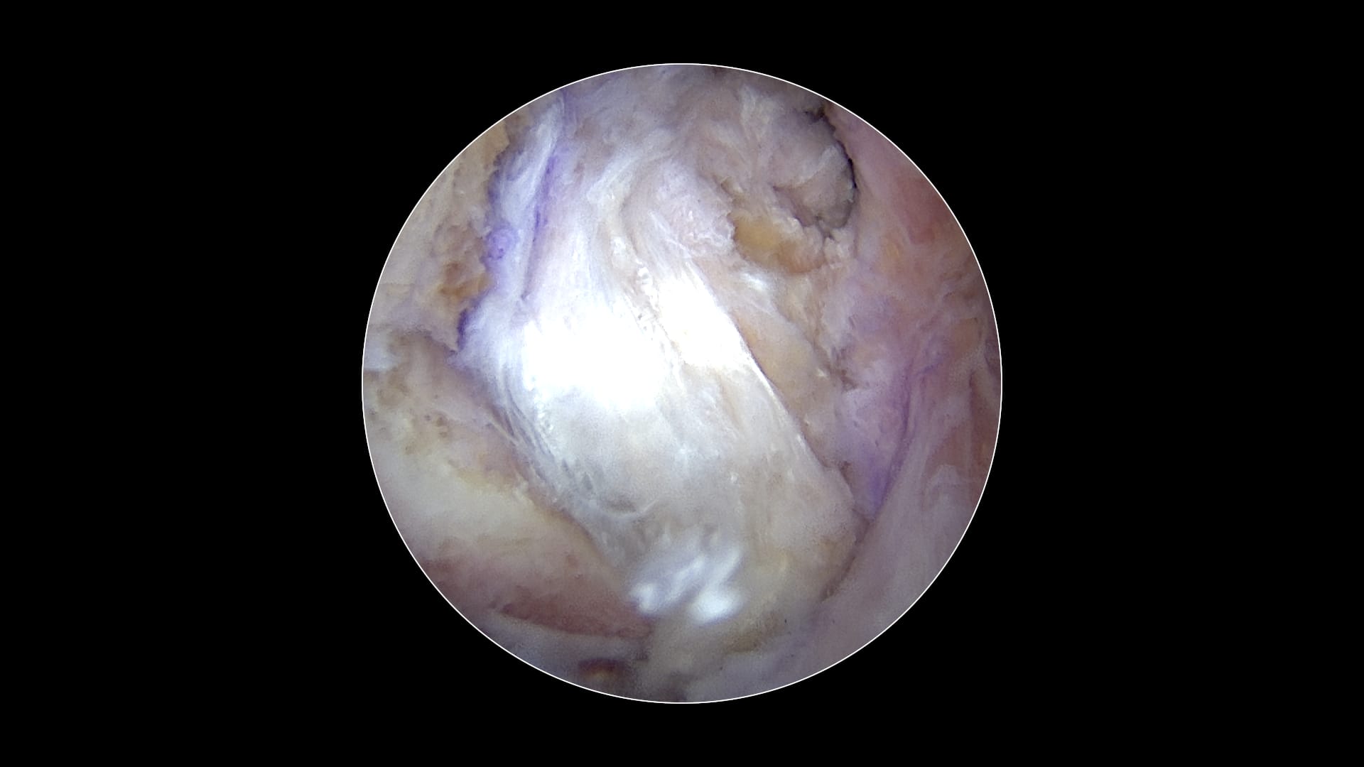 All-Inside PCL Reconstruction Using a Quadriceps Tendon Autograft