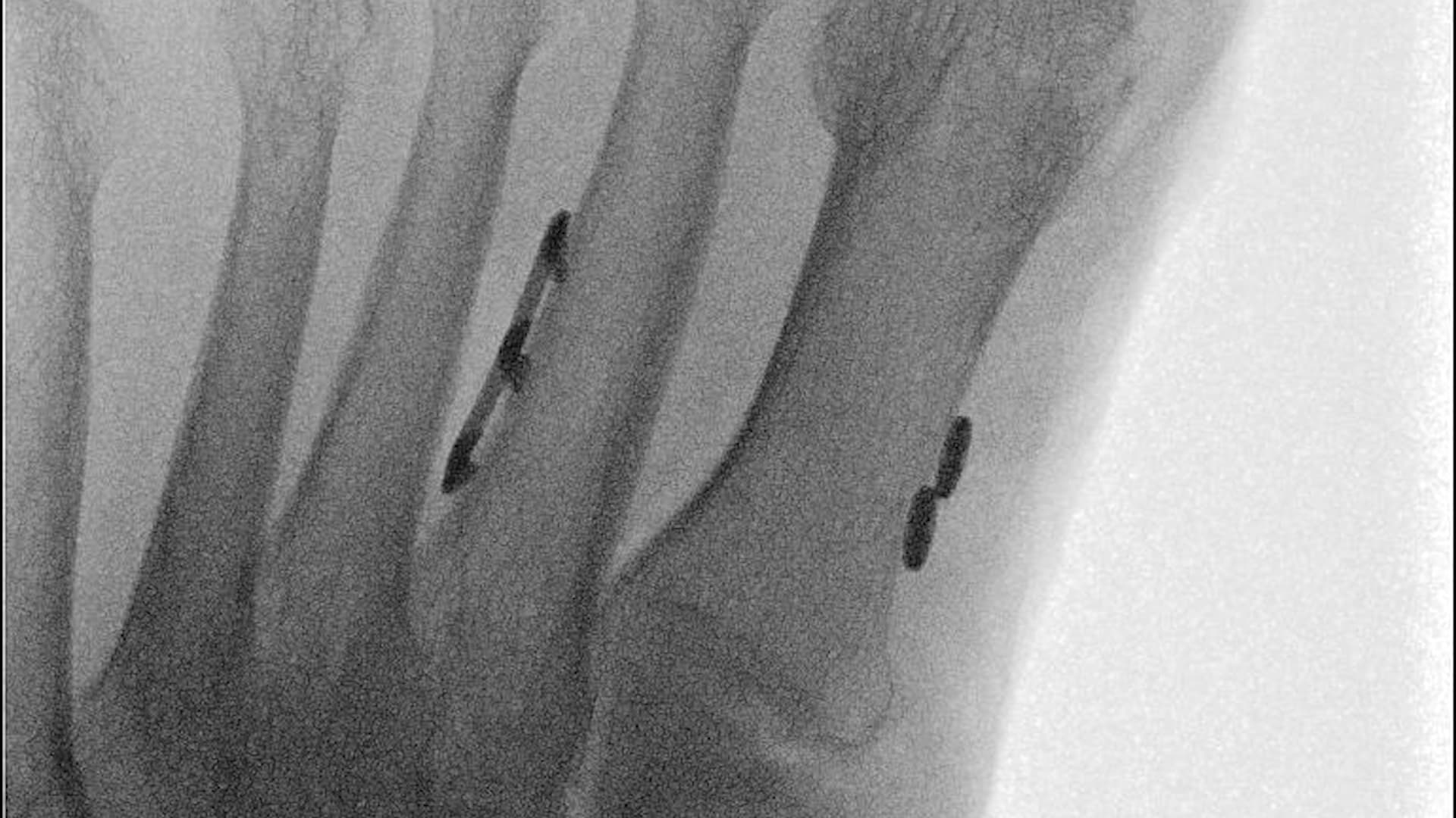 Arthrex - Adjunct Fixation With the Knotless Mini TightRope® System for ...