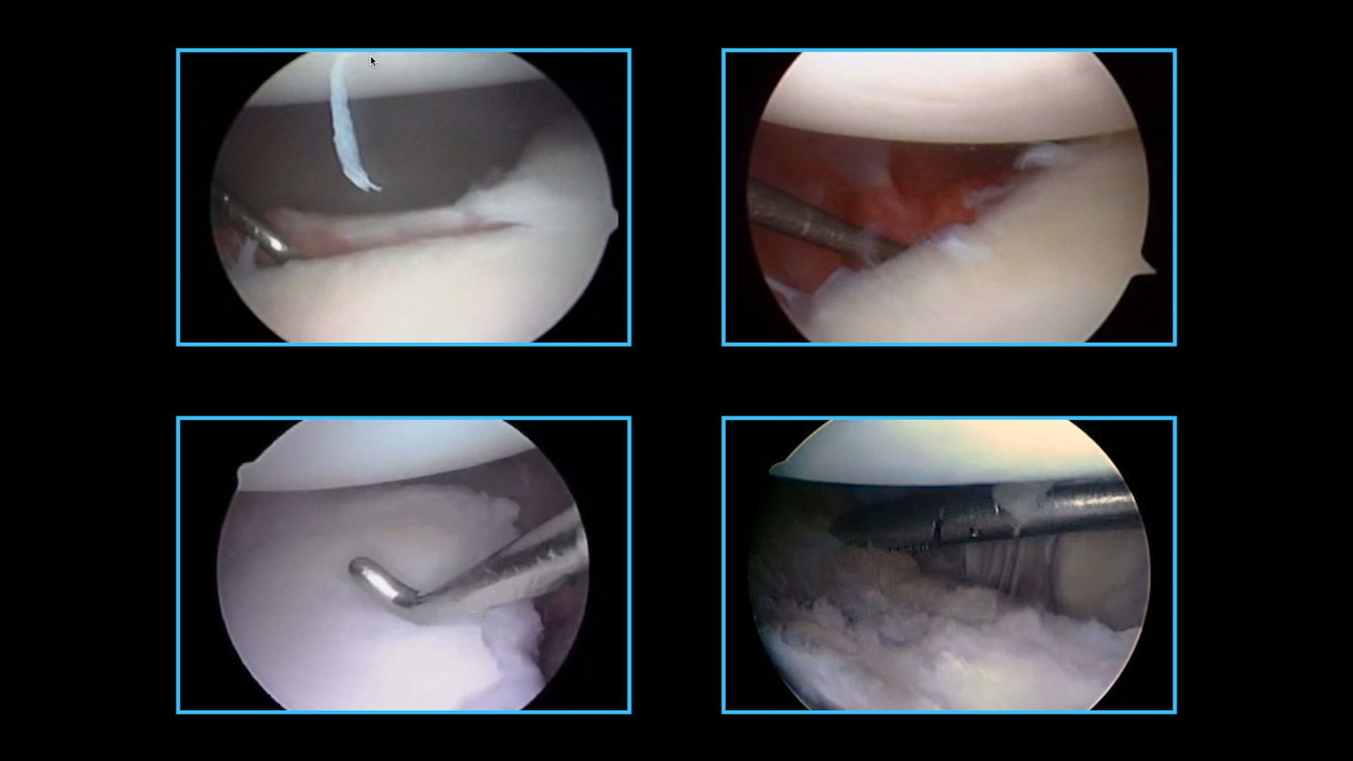 Arthroscopic Shoulder Stabilization Using Knotless FiberTak® Anchors