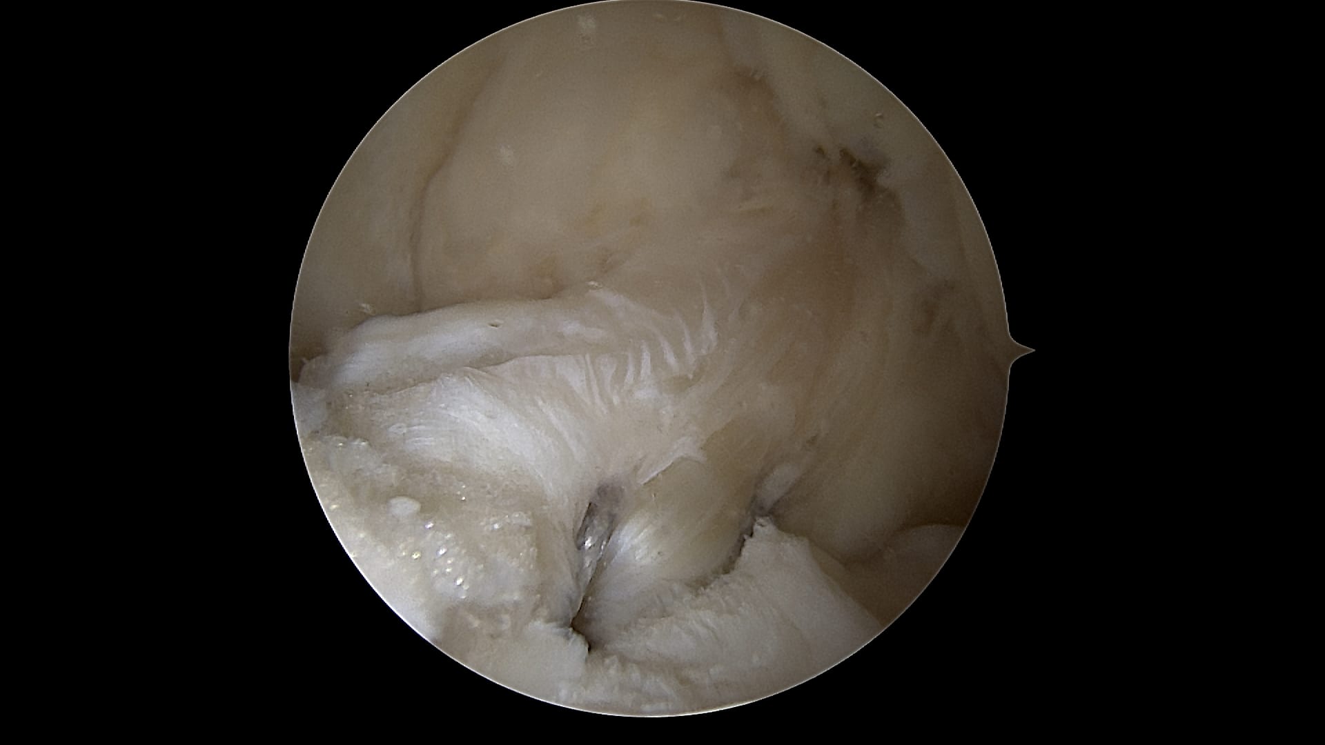 Primary Repair of a Tibial-Sided ACL PL Bundle: ACL Repair TightRope® Implant and FiberRing™ Suture