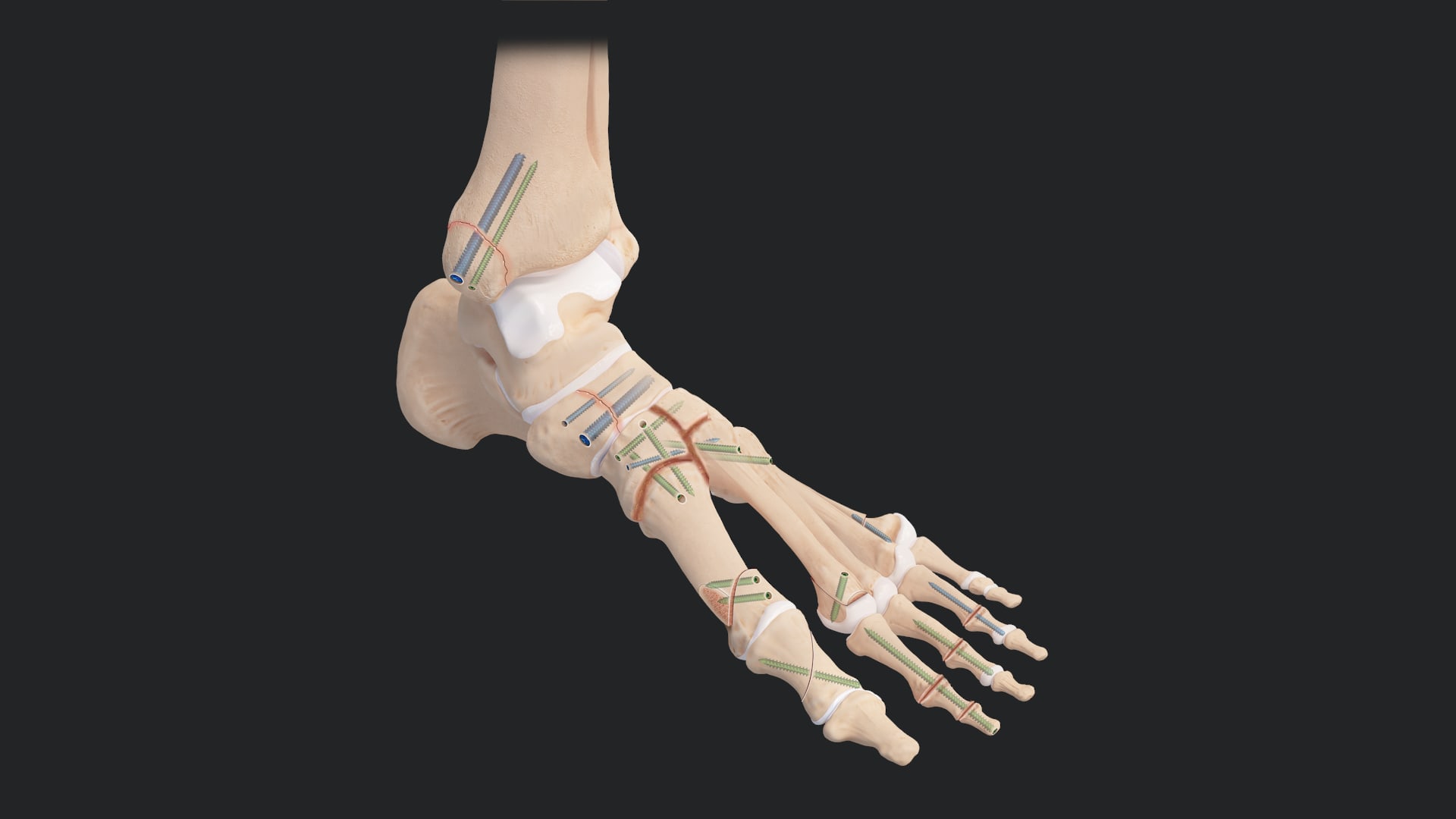 Snap-Off Compression FT Pins: Forefoot Surgical Technique Pearls