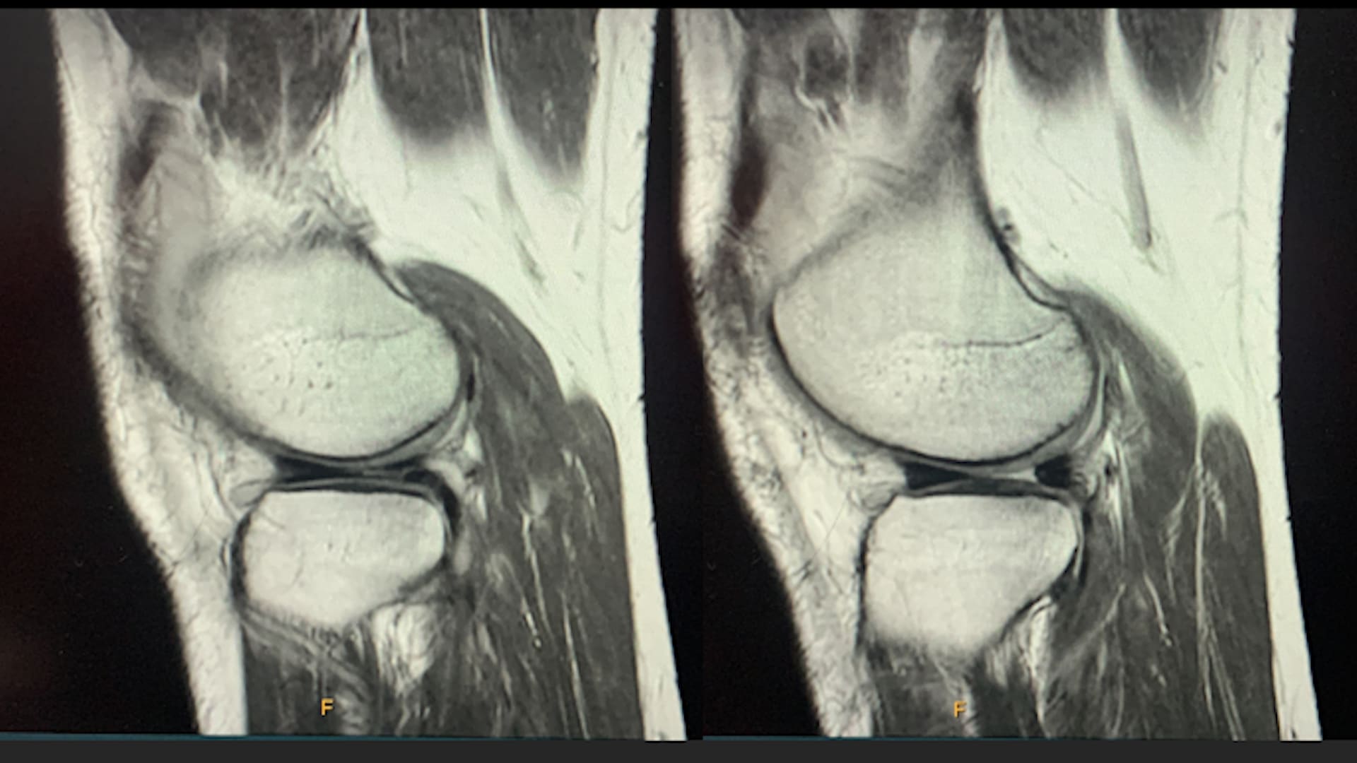 Evolution From Traditional Arthroscopy to Nano Technology