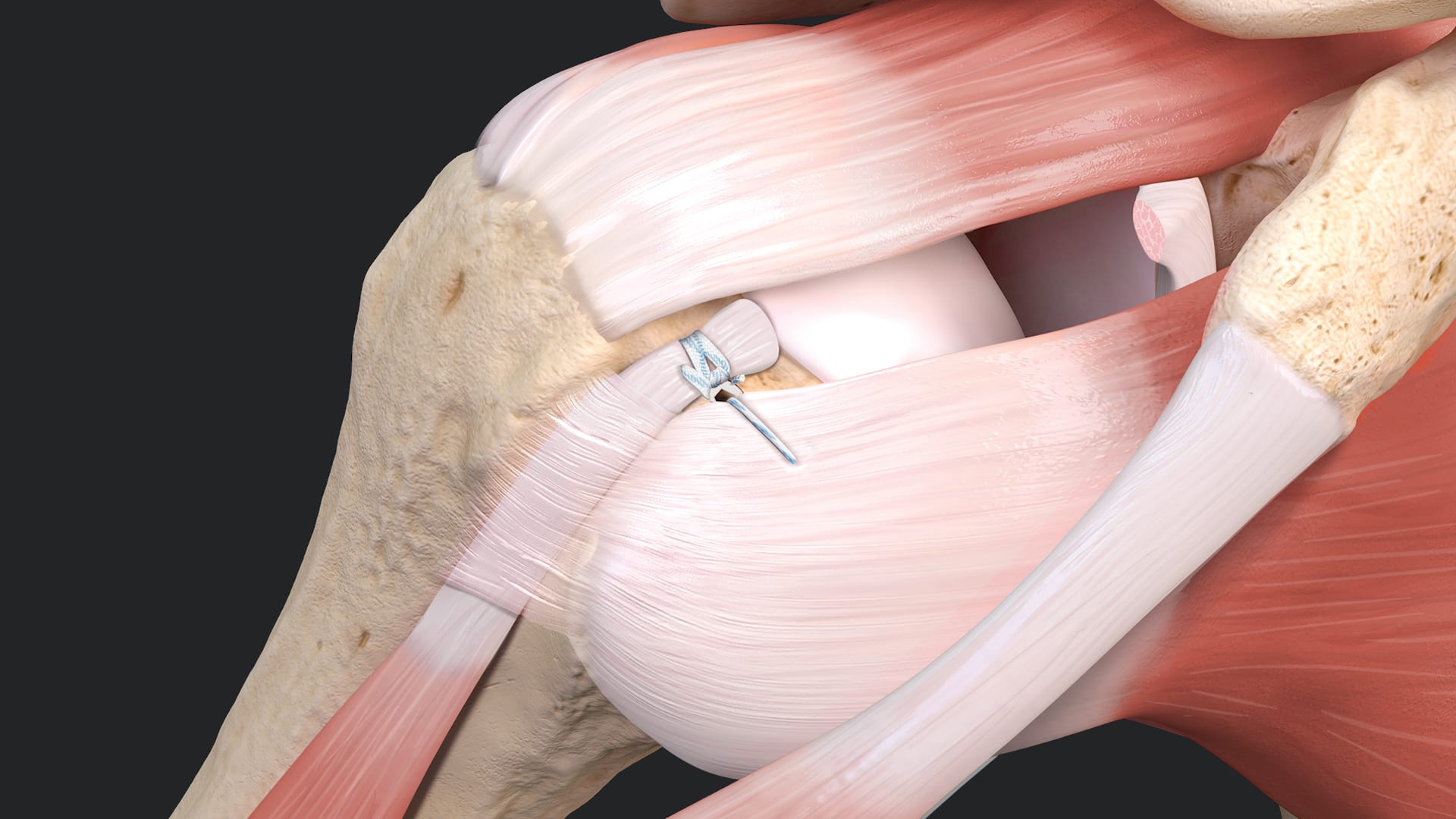 Biceps Tenodesis Using the Loop 'N' Tack™ System