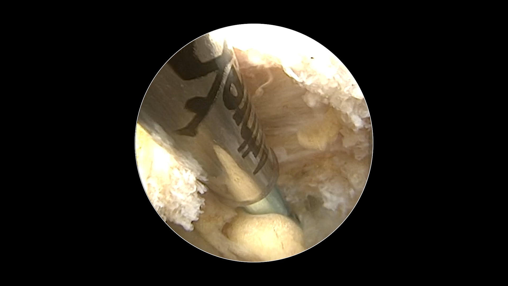 Endoscopic Approach to Medial Branch Nerve Transection