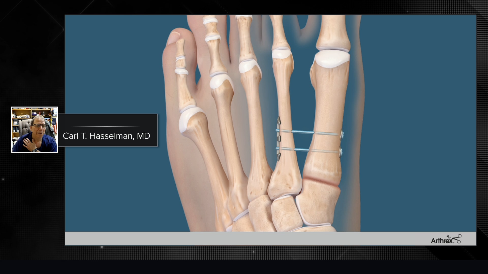 Knotless Mini TightRope® System: Clinical Lessons and the Evolution in Technology