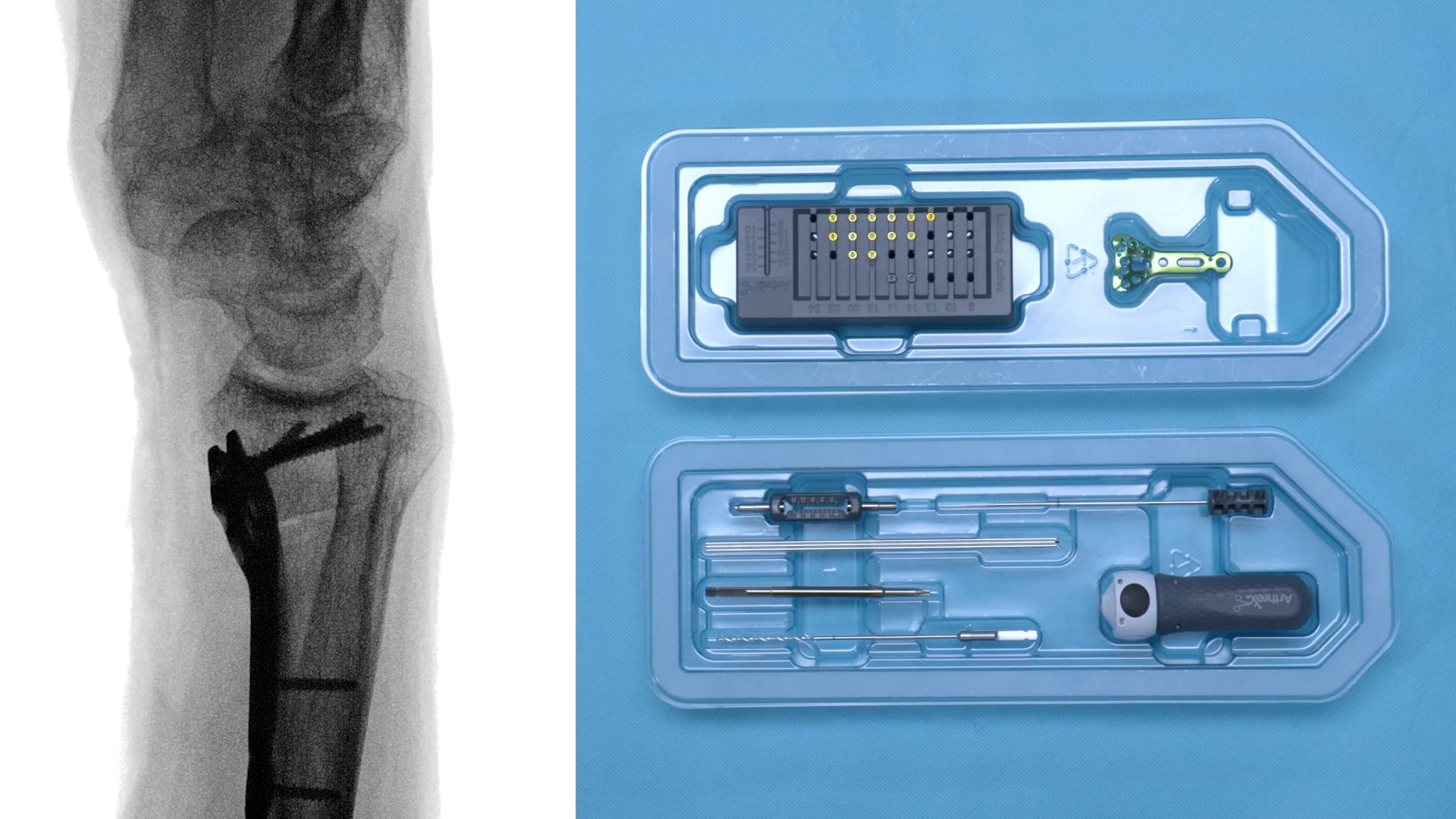 Distal Radius Fracture Fixation With the Sterile Distal Radius Implant Kit