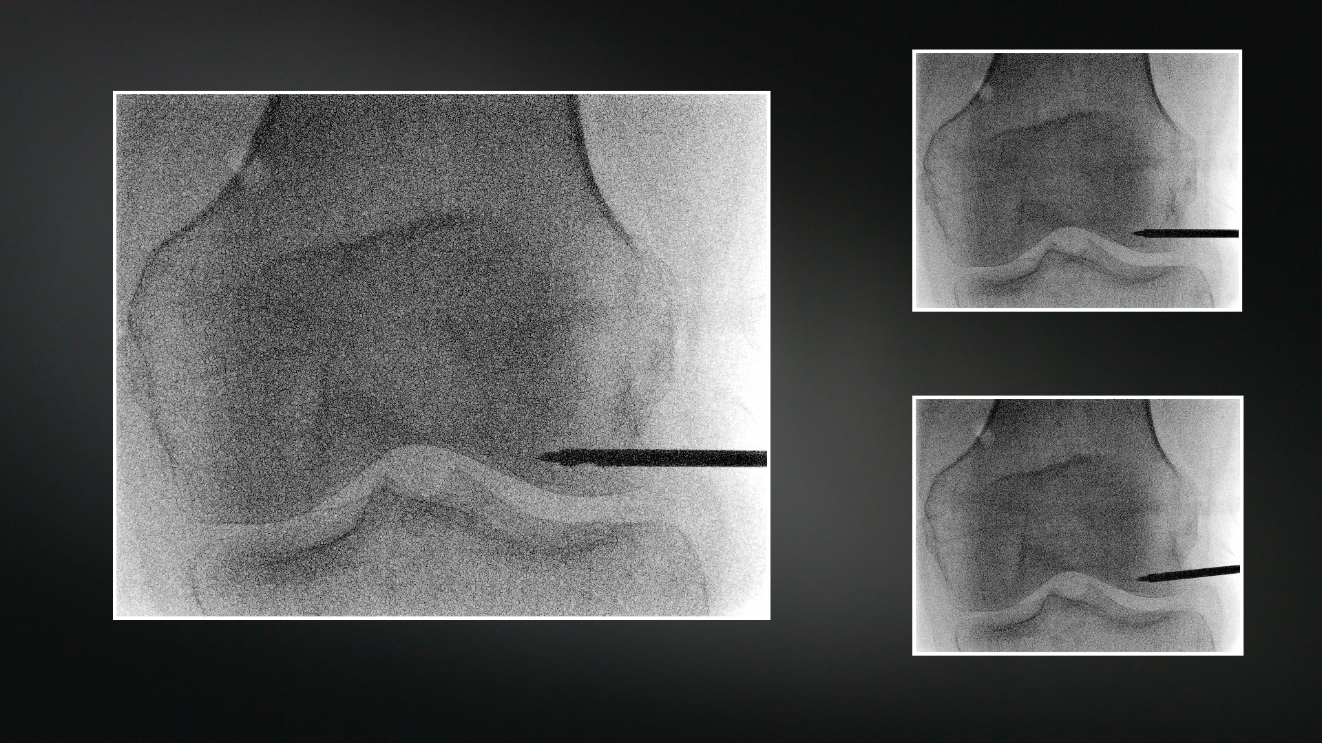 IOBP® Knee Technique in Clinic