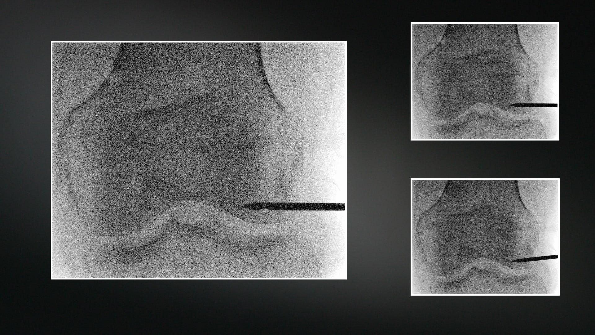 IOBP® Knee Technique in Clinic