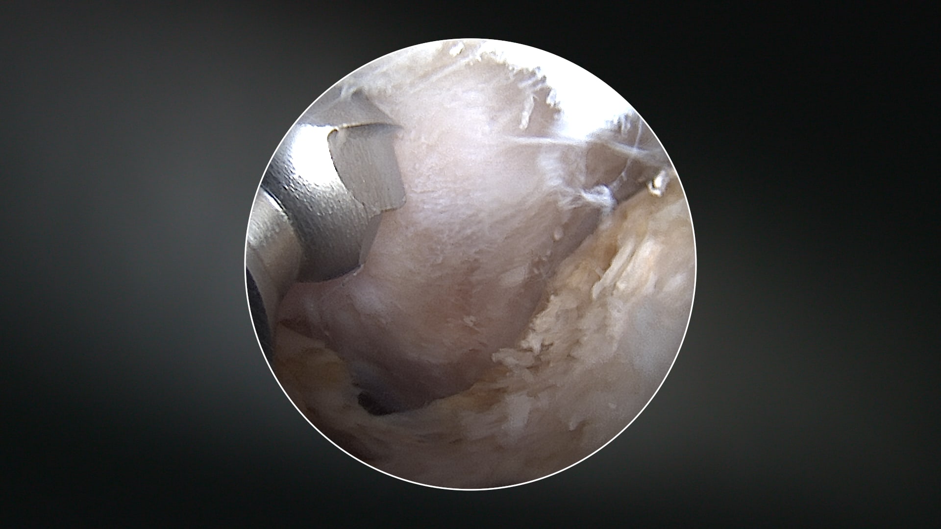 Medial Cam Osteochondroplasty Resection of the Femoral Neck Using a
Curved Burr