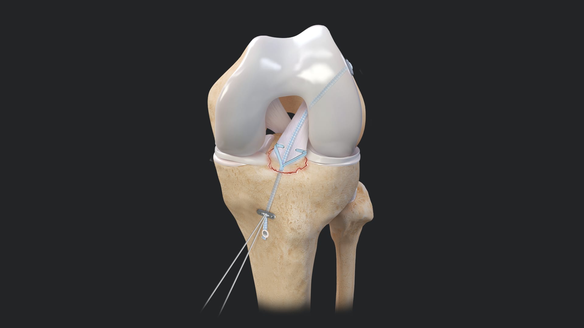 Tibial Spine Avulsion Repair Using the ACL Repair TightRope® Implant With FiberRing™ Sutures