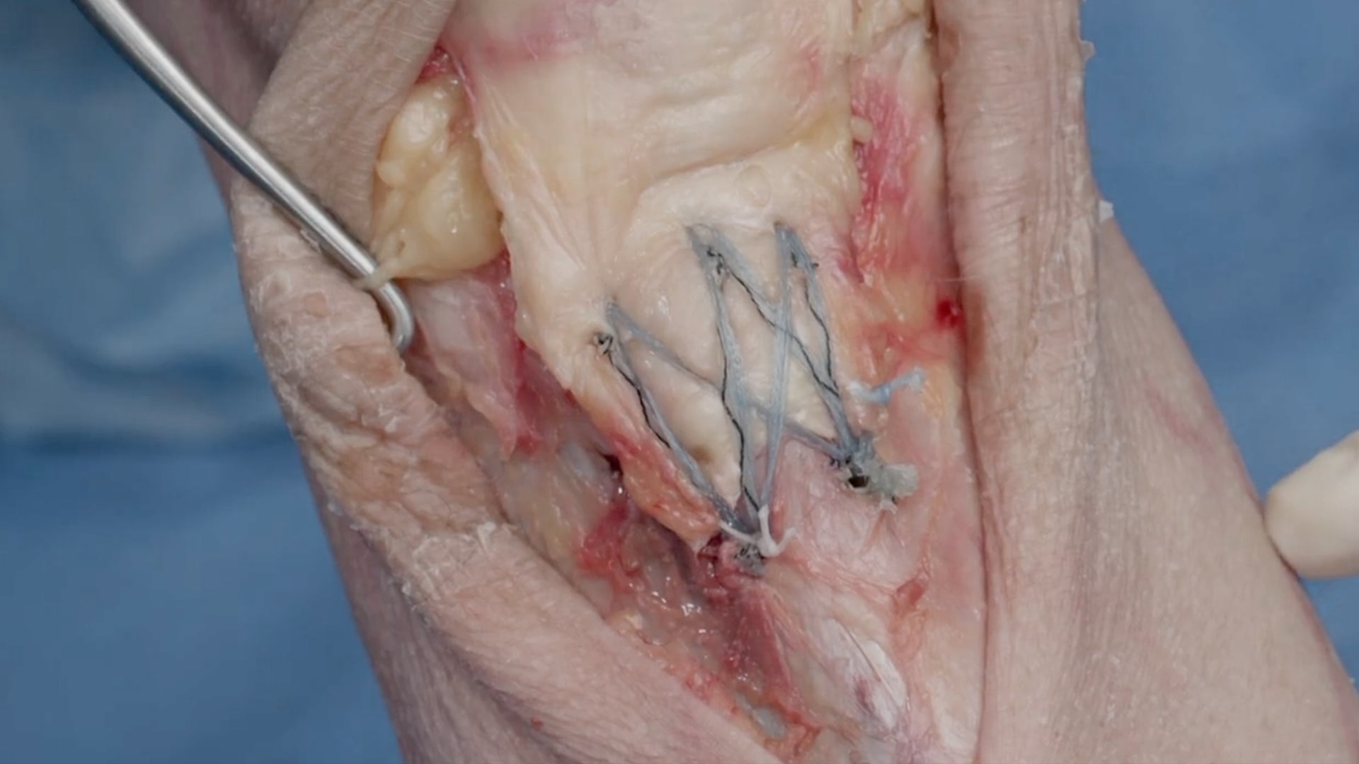 Distal Patellar Tendon SpeedBridge™ Repair Using Knee FiberTak® Anchors