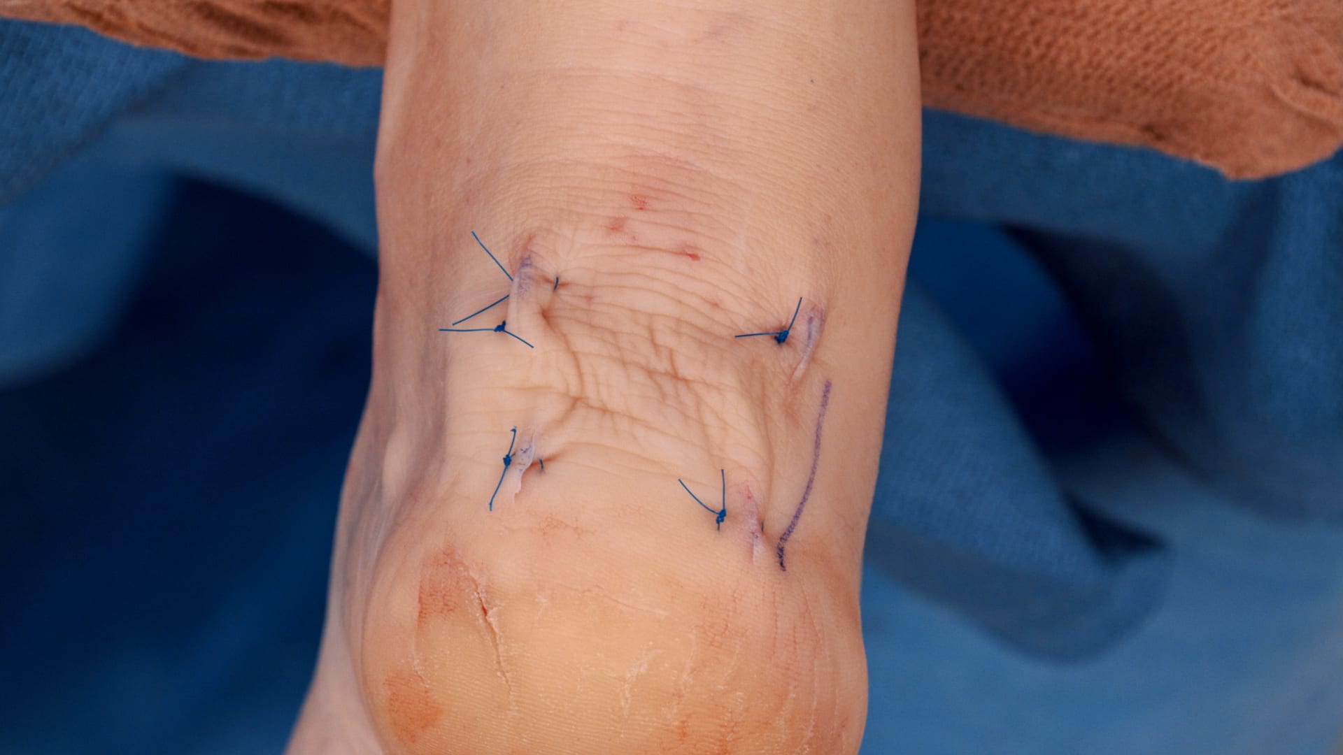 MIS FiberTak® Achilles SpeedBridge™ Procedure for Insertional Achilles Pathology