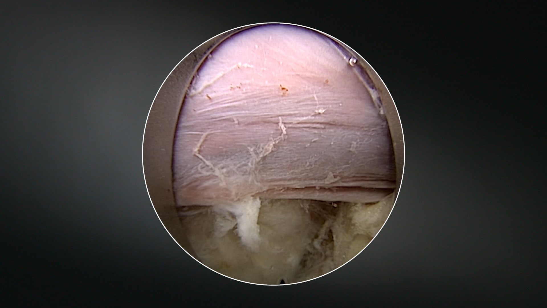 Endoscopic Approach to Interlaminar Discectomy