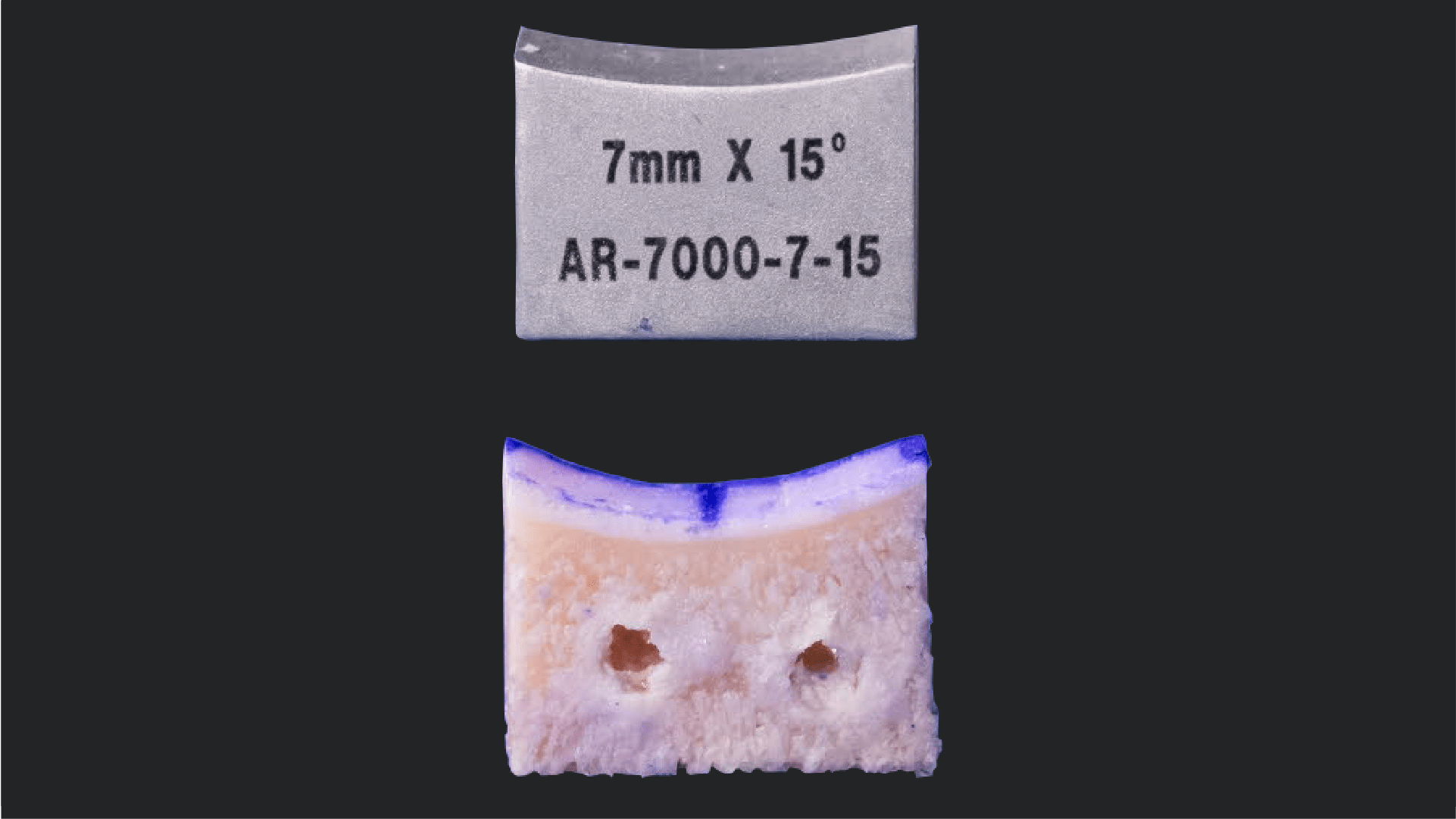 Distal Tibia Allograft for the Treatment of Glenoid Bone Loss