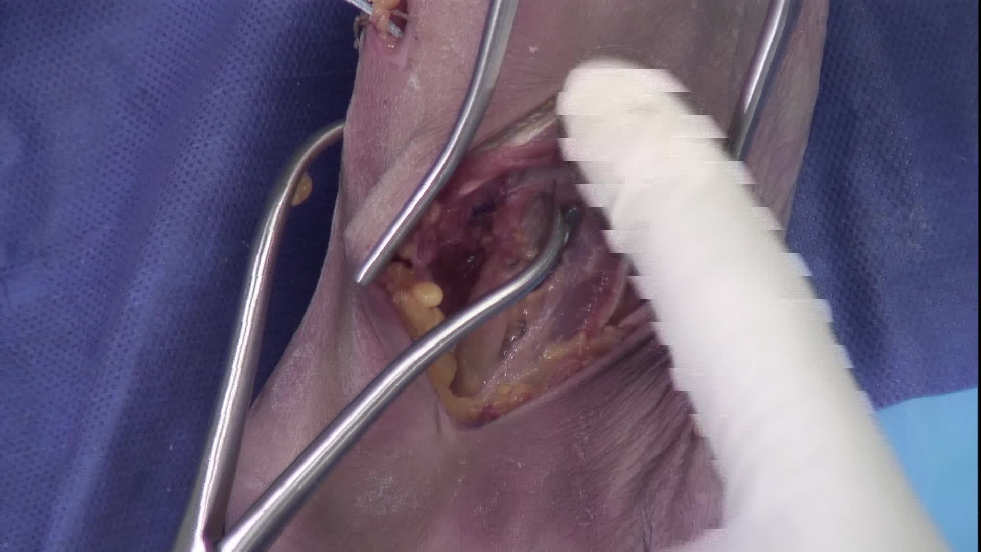 Lisfranc ORIF With the InternalBrace™ Ligament Augmentation Procedure