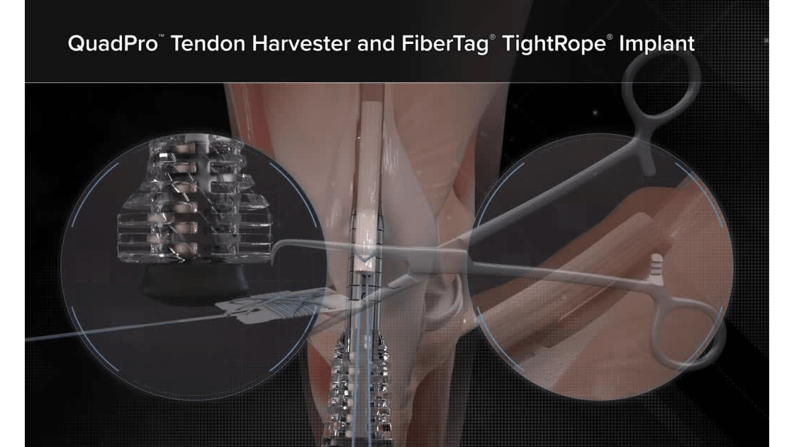 QuadPro™ Tendon Harvester and FiberTag® TightRope® Implant