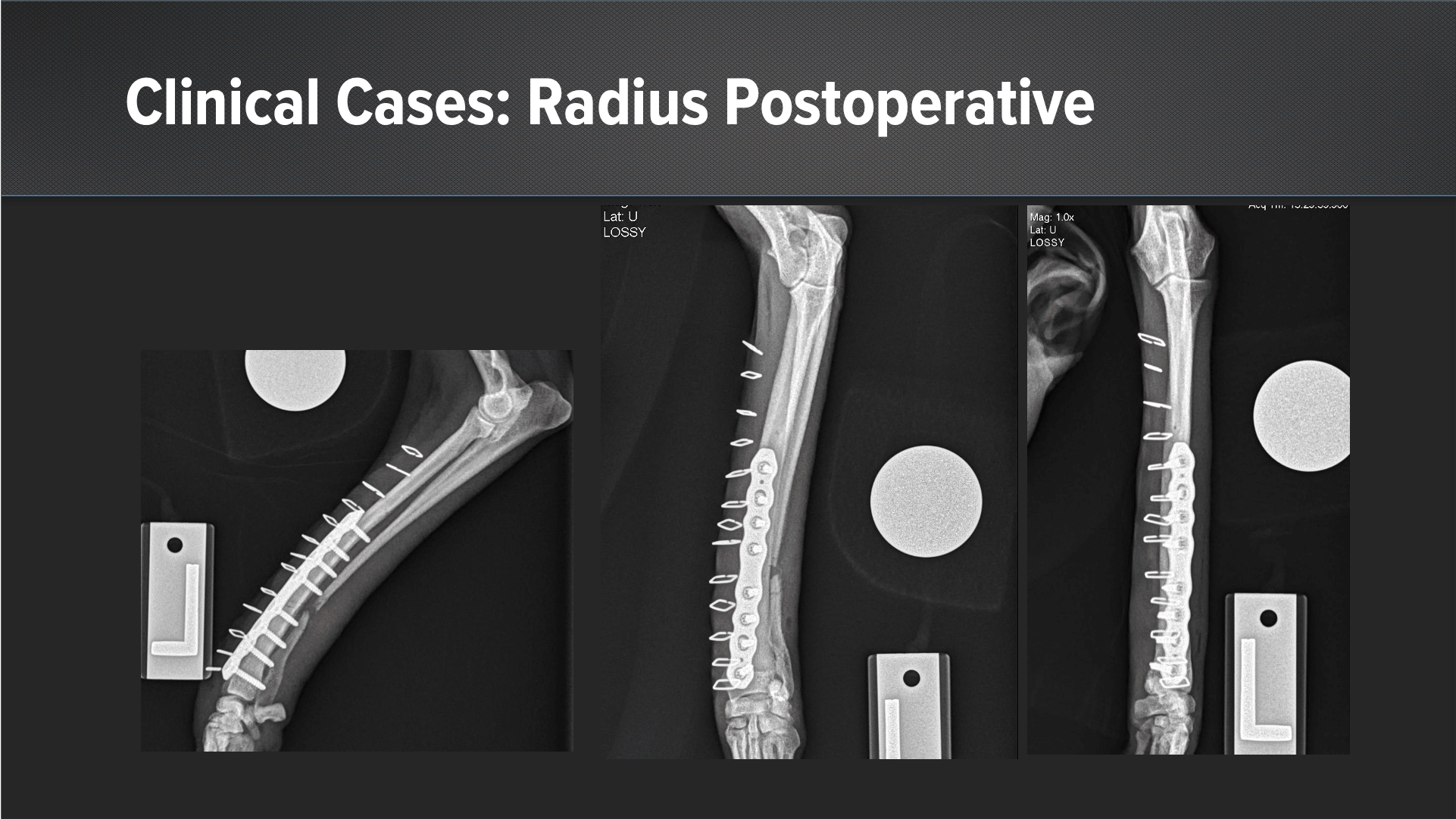 OrthoLine™ Universal Plating System: Clinical Case Series II