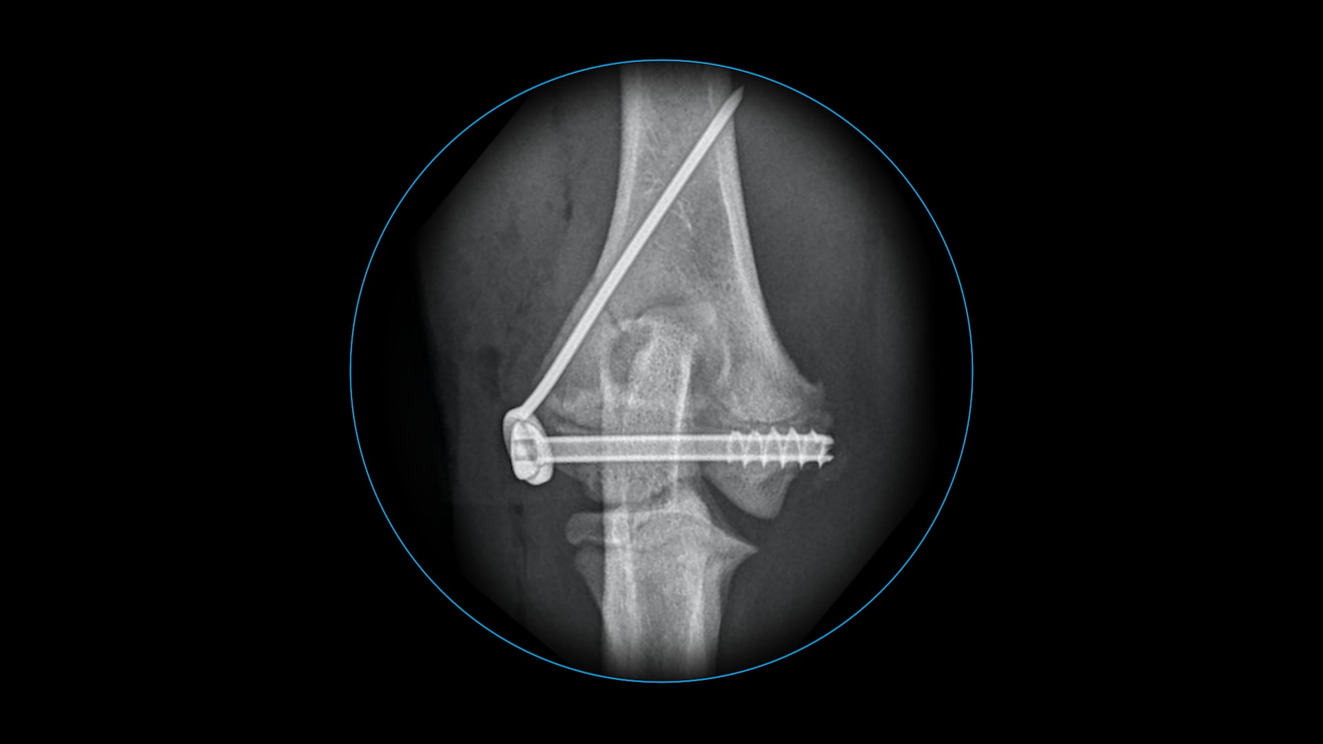 Fracture Reduction Methods