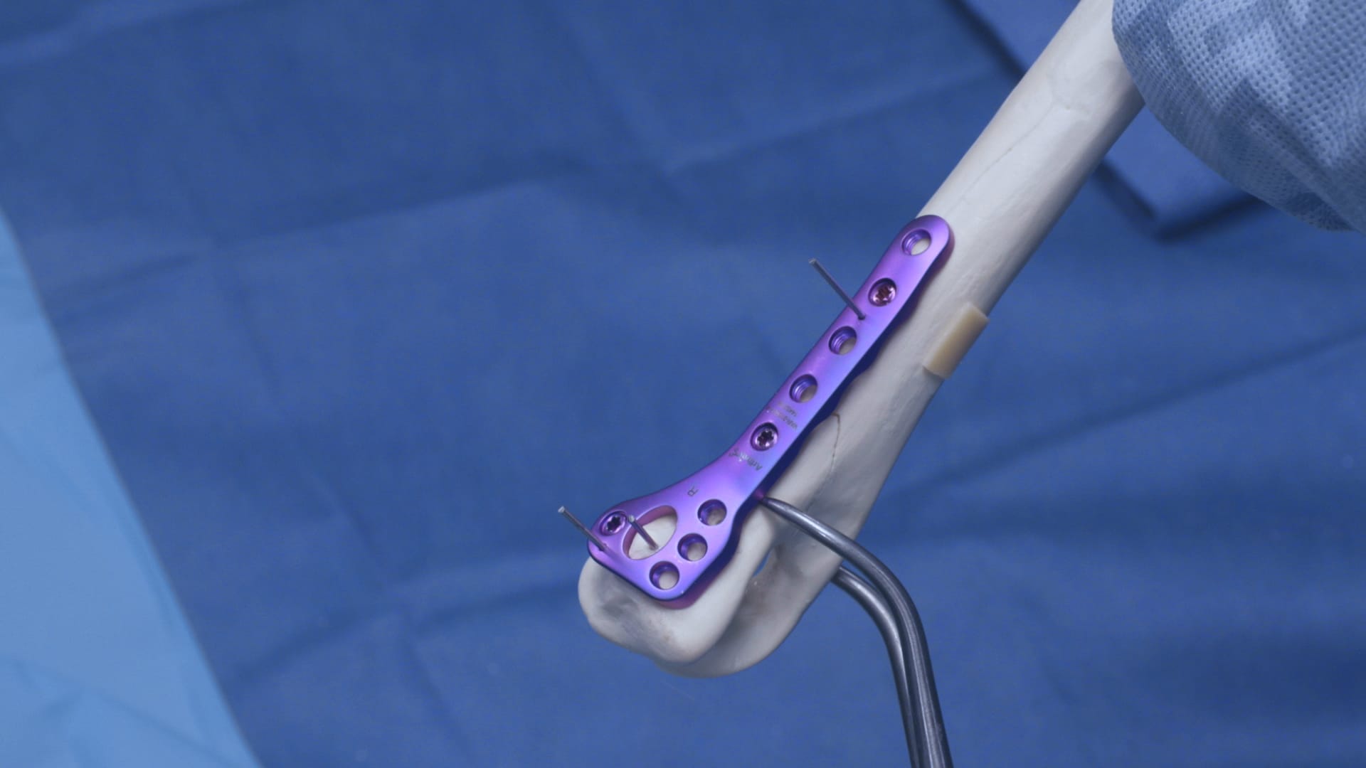 OrthoLine™ Distal Humeral Fracture System: Sawbone Application on a Canine Elbow Procedure Demonstration