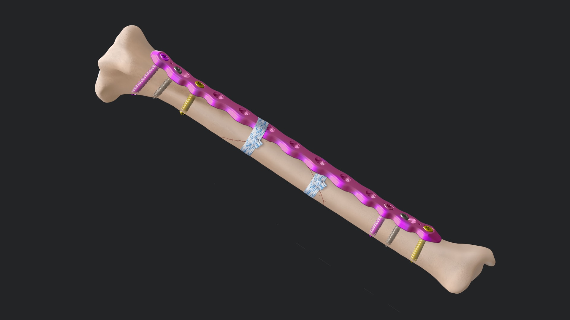 Surgical Approach to the Lateral Radius