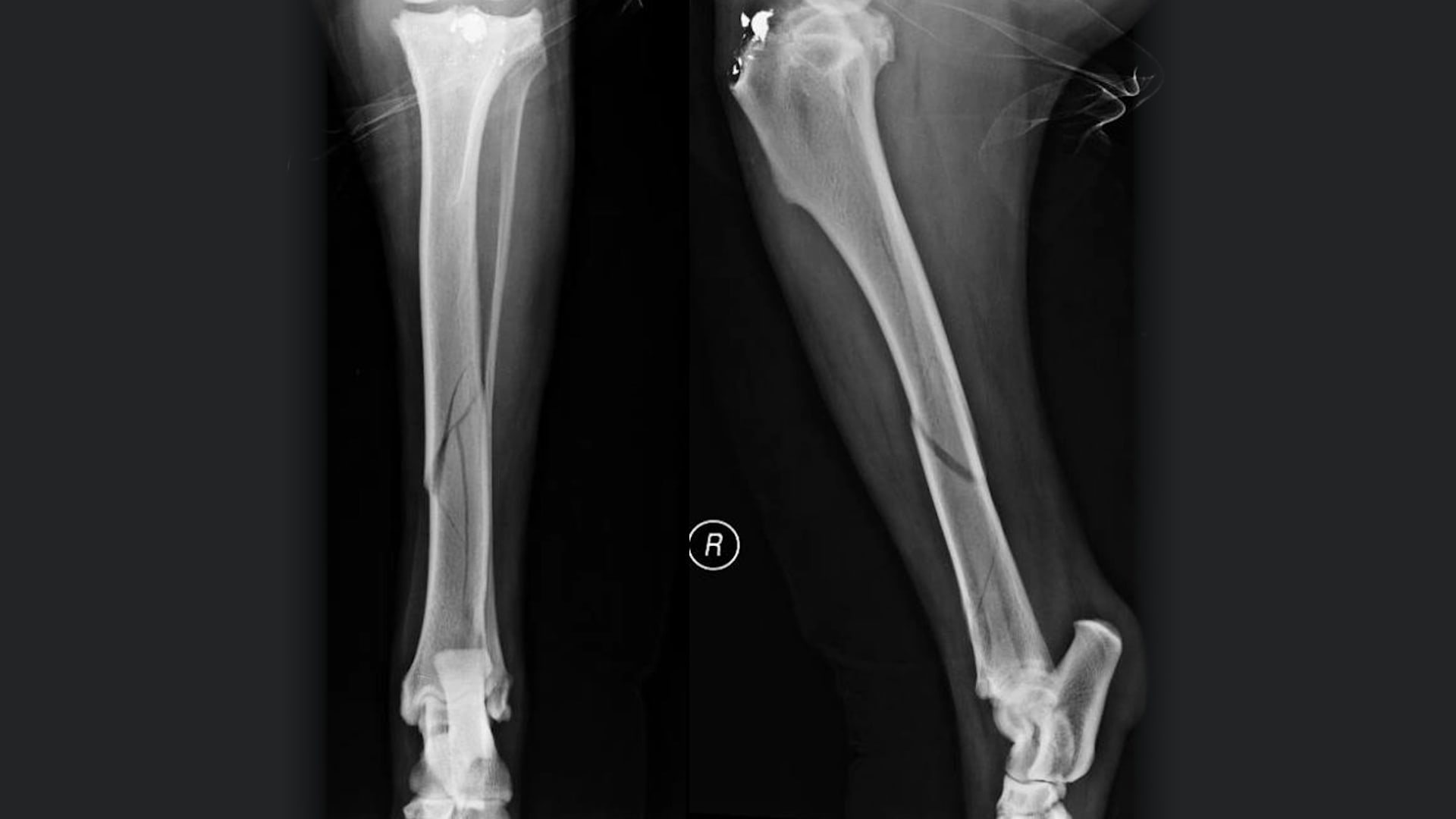 Fracture Assessment Score