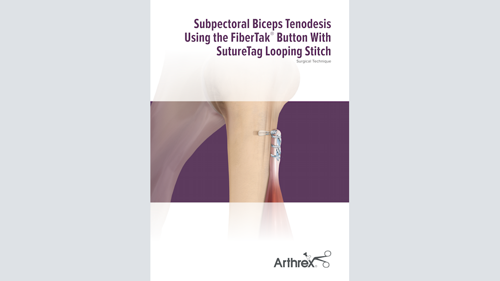 Subpectoral Biceps Tenodesis Using the FiberTak® Button With SutureTag Looping Stitch