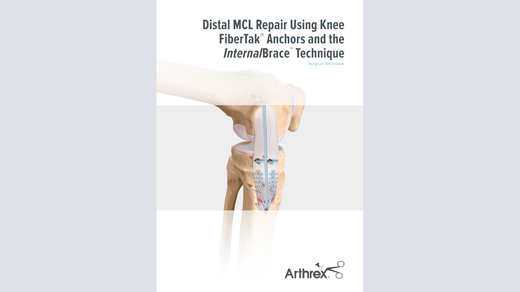 Distal MCL Repair Using Knee FiberTak®  Anchors and the InternalBrace™ Technique