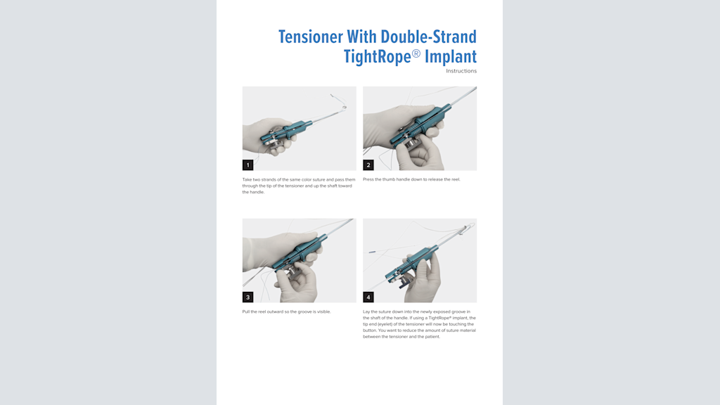 Tensioner With Double-Strand TightRope® Implant