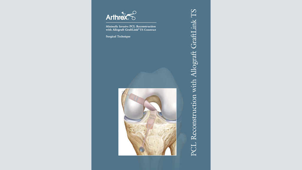Minimally Invasive PCL Reconstruction with Allograft GraftLink® TS Construct