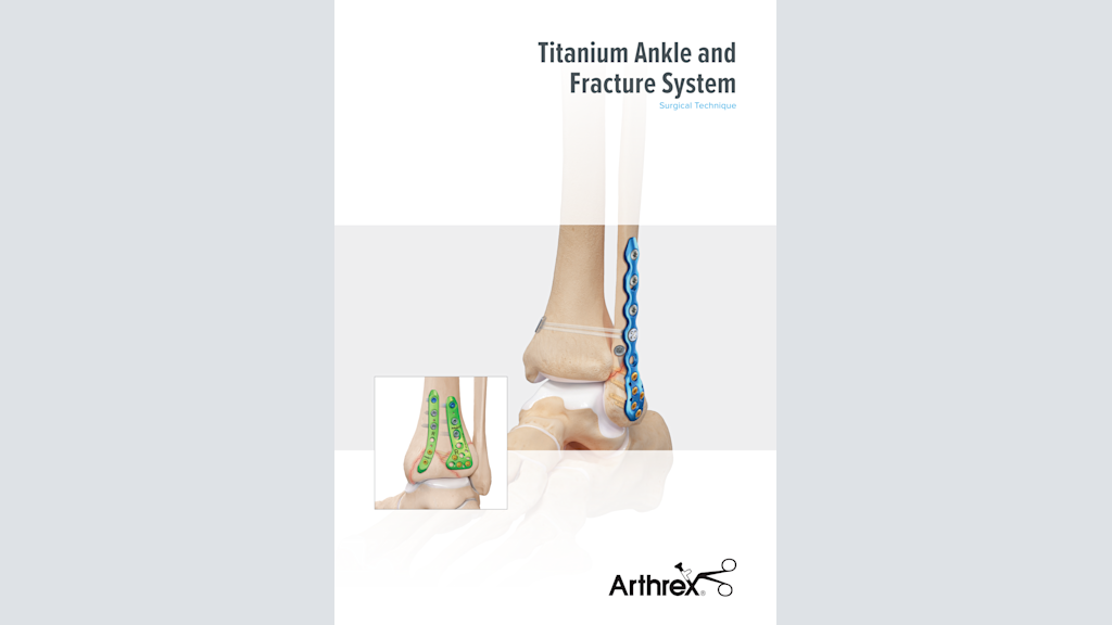 Titanium Ankle and Fracture System