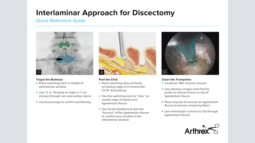 Interlaminar Approach for Discectomy