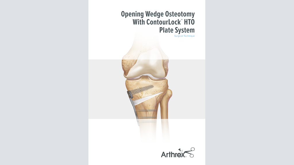 Opening Wedge Osteotomy With ContourLock™ HTO Plate System Surgical Technique