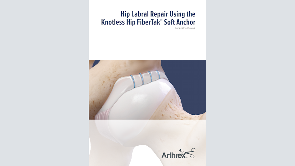 Hip Labral Repair Using the Knotless Hip FiberTak® Soft Anchor