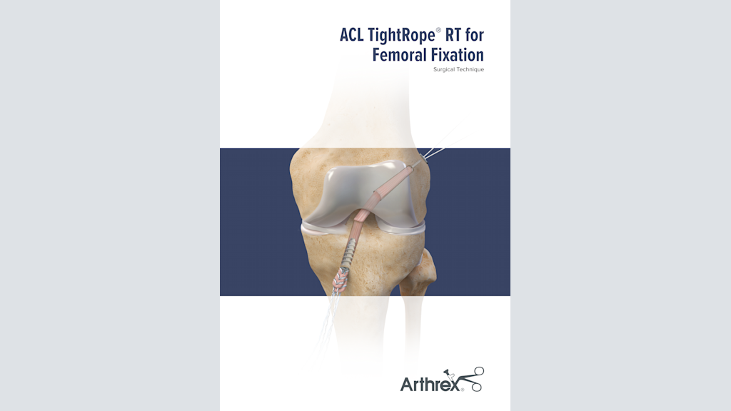 ACL TightRope® RT for Femoral Fixation