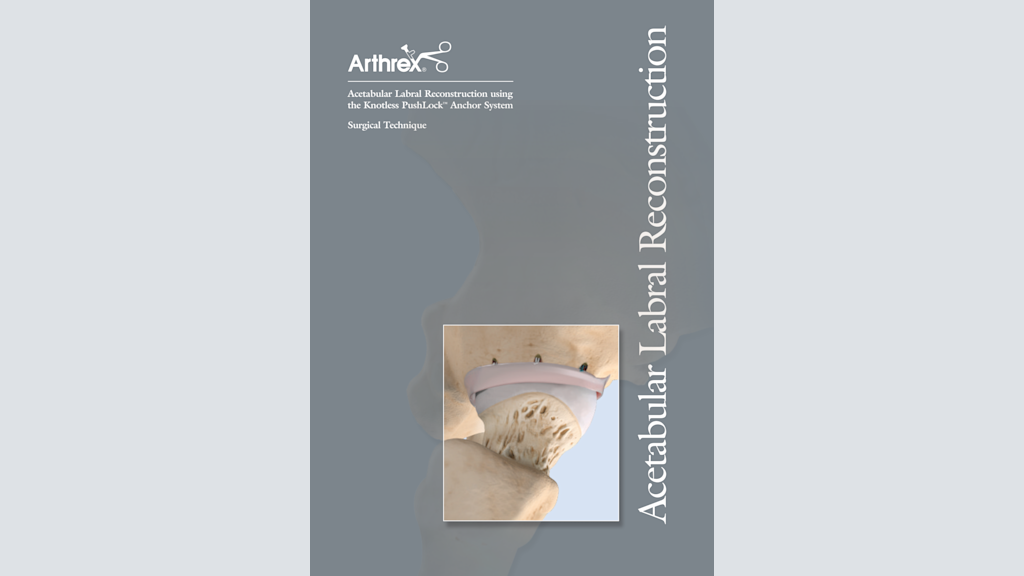 Acetabular Labral Reconstruction using the Knotless PushLock™ Anchor System